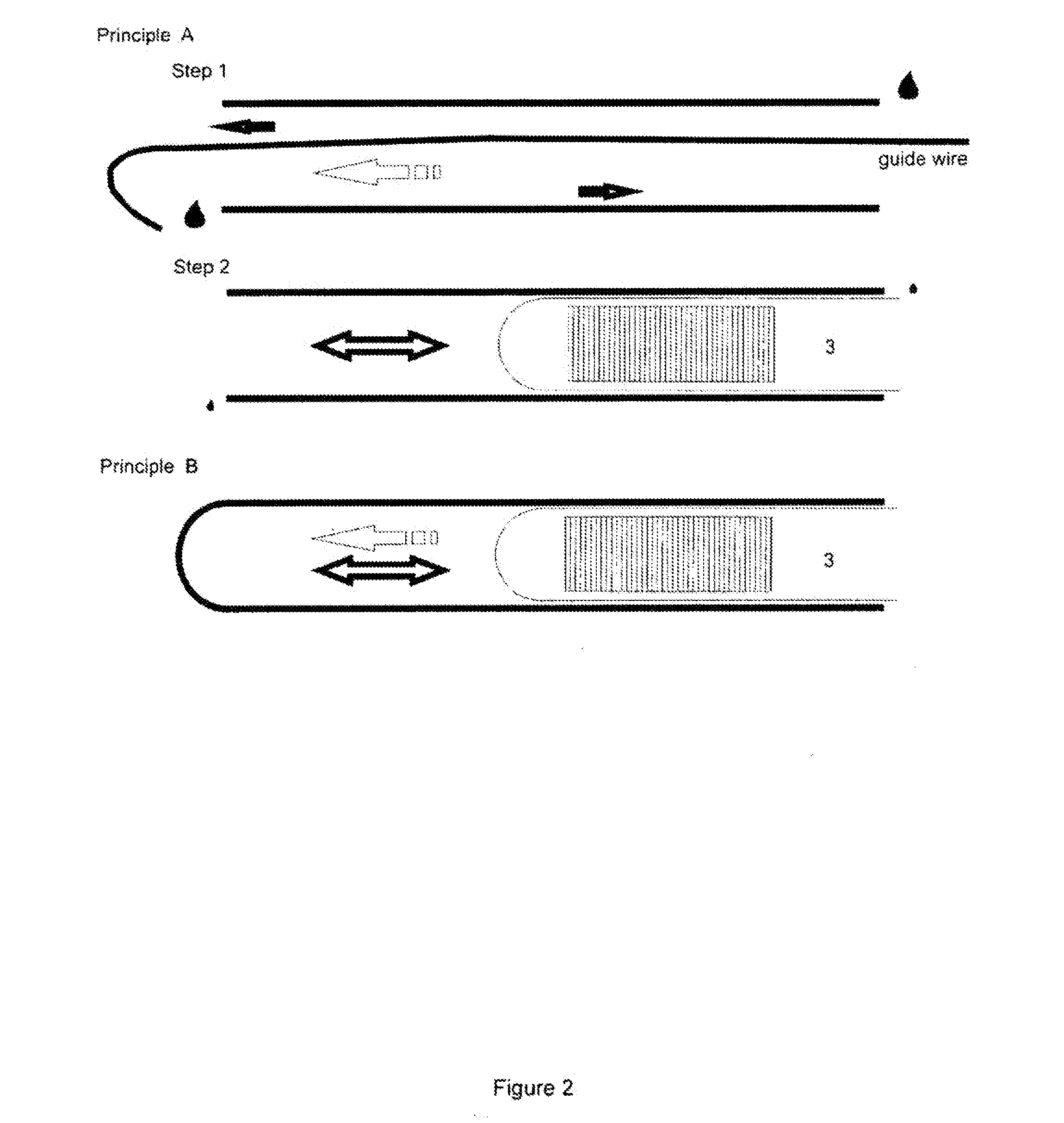 Light-Based Method for the Endovascular Treatment of Pathologically Altered Blood Vessels