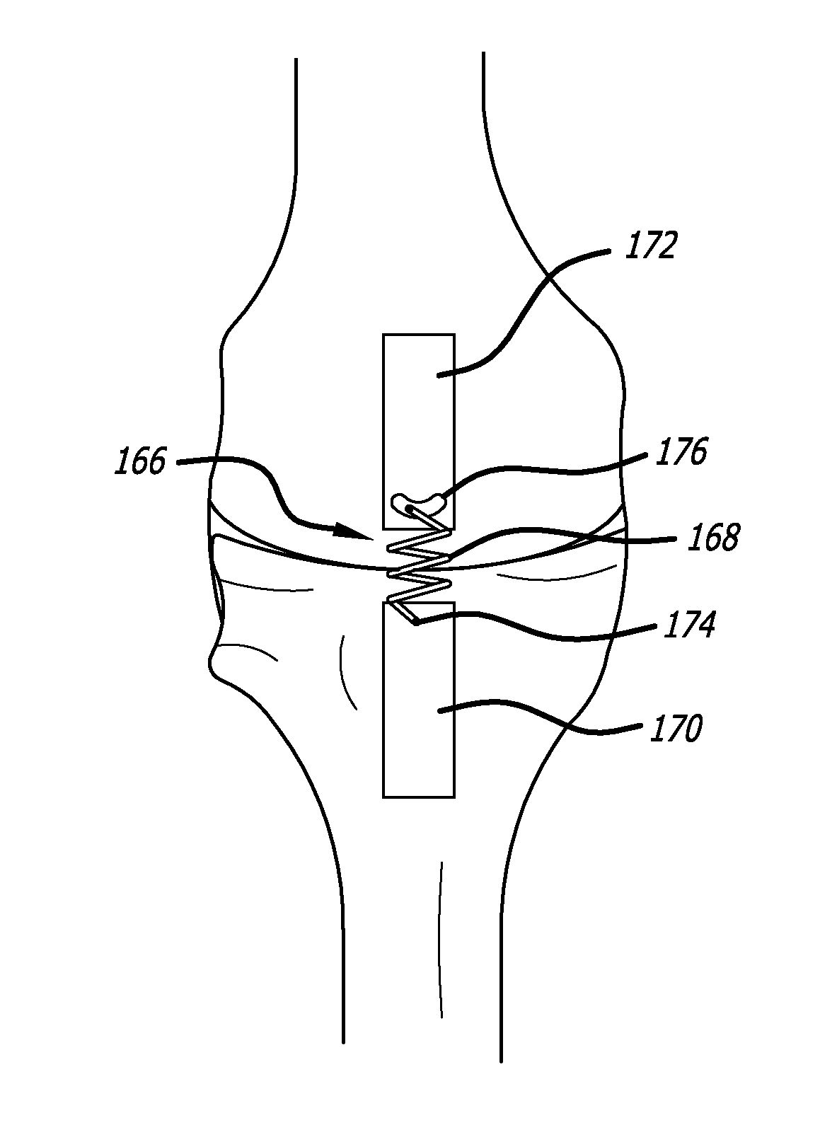 Extra-Articular Implantable Load Sharing Systems