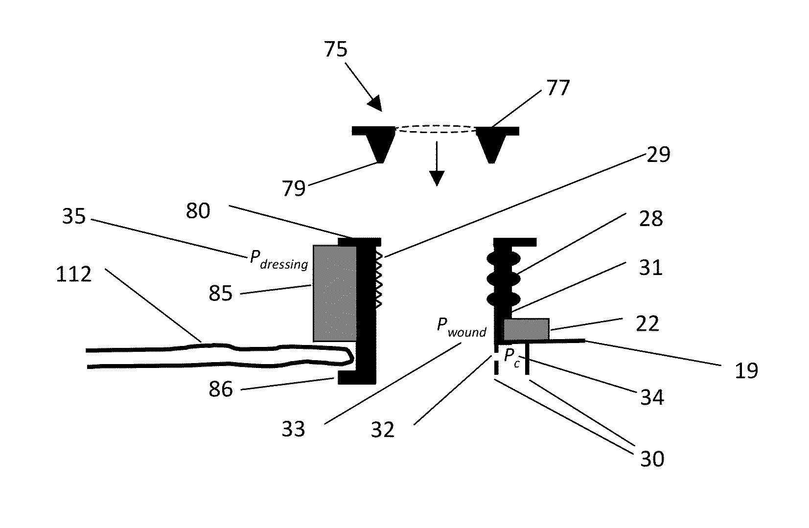 Devices and methods for treatment of fistulas and complex wounds