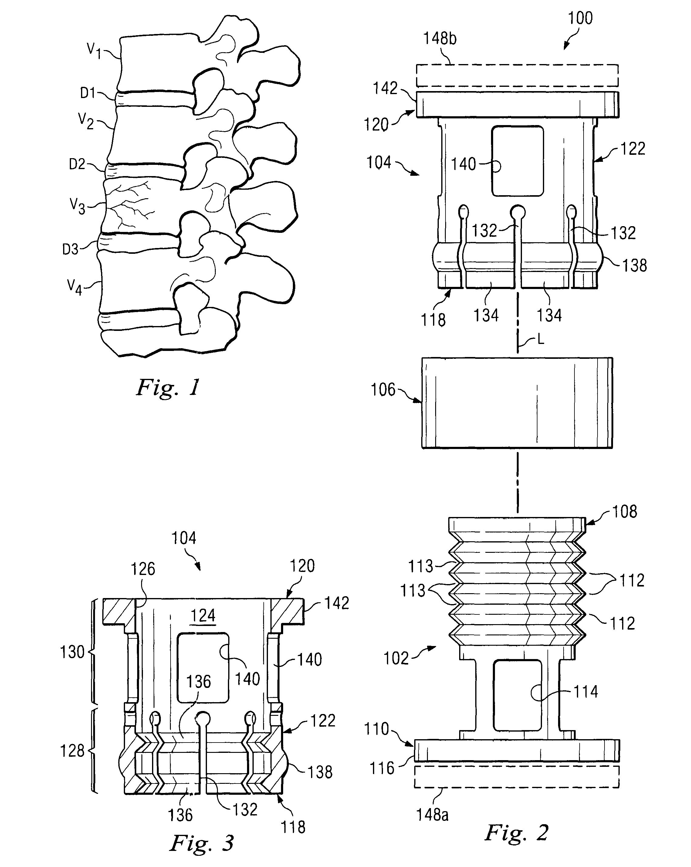 Ratcheting expandable corpectomy/vertebrectomy cage