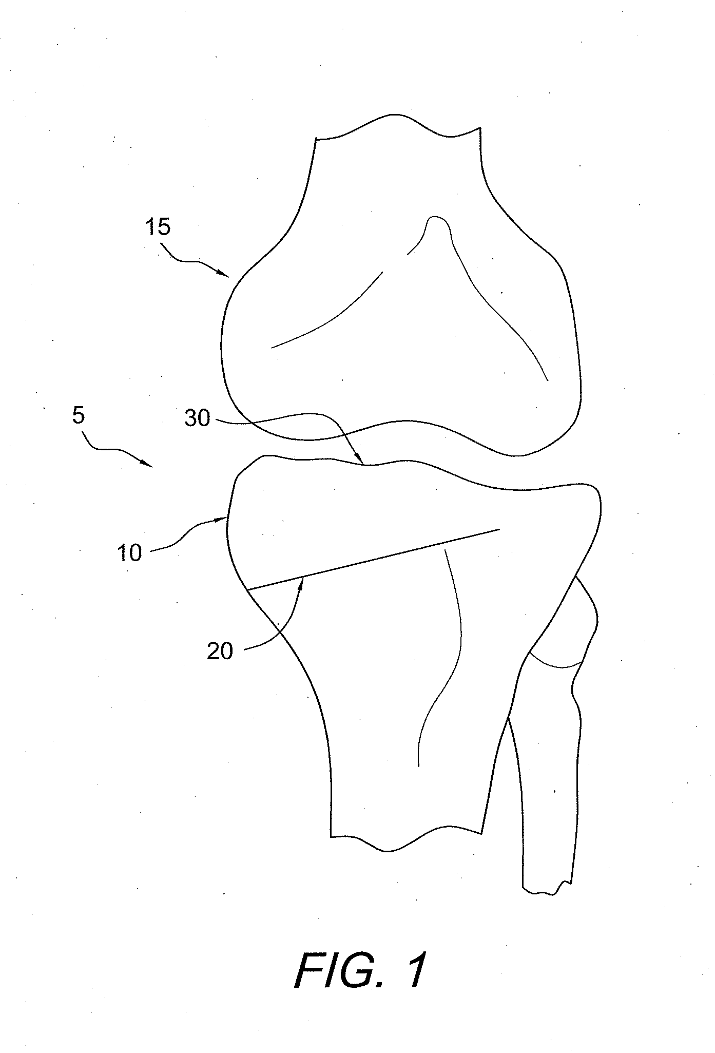 Method and apparatus for performing an open wedge, high tibial osteotomy