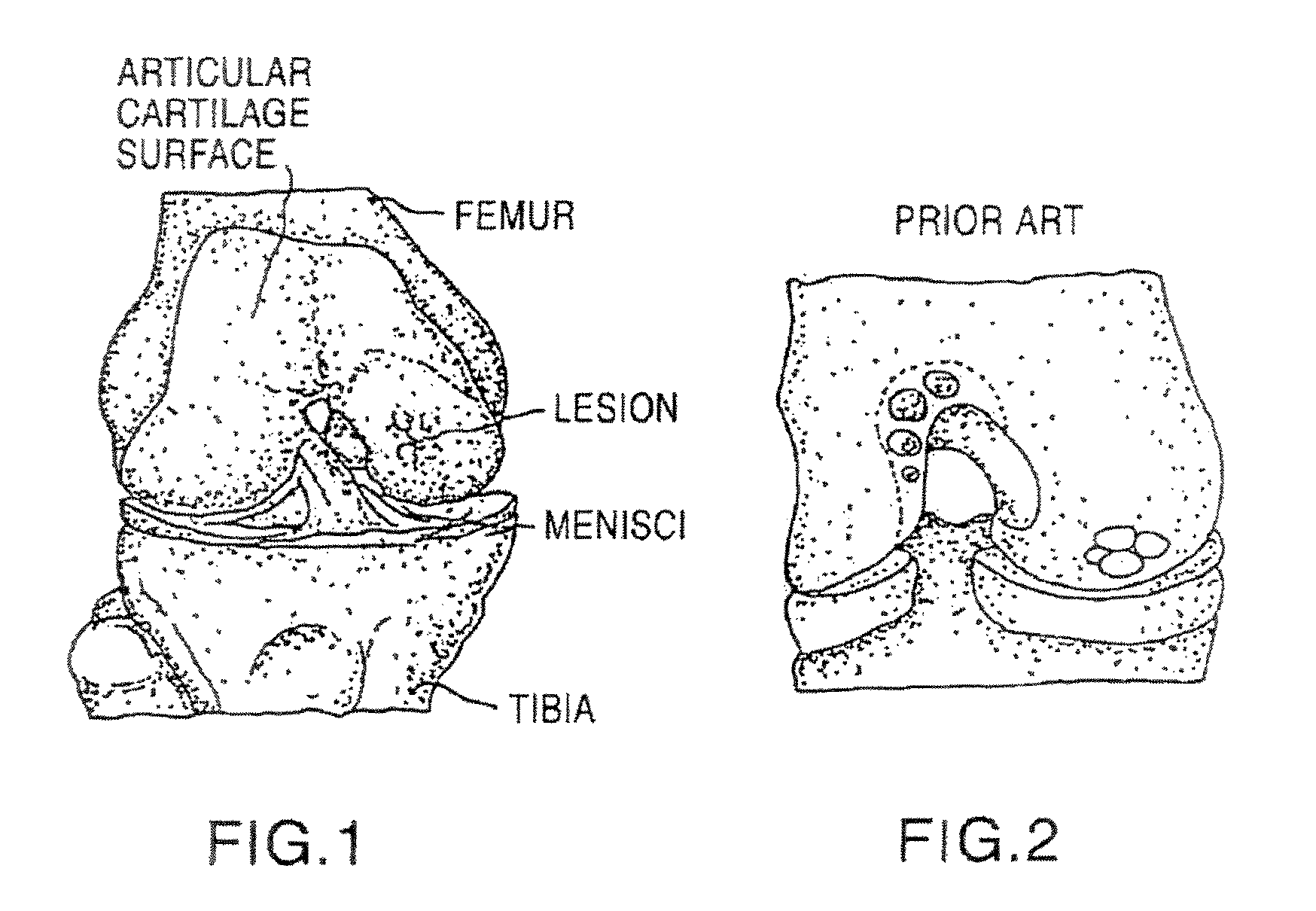 Cancellous construct with support ring for repair of osteochondral defects