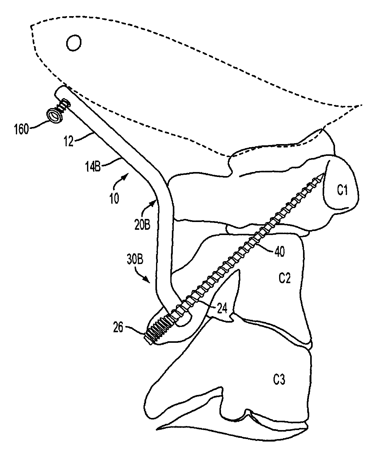 Occipitocervical plate