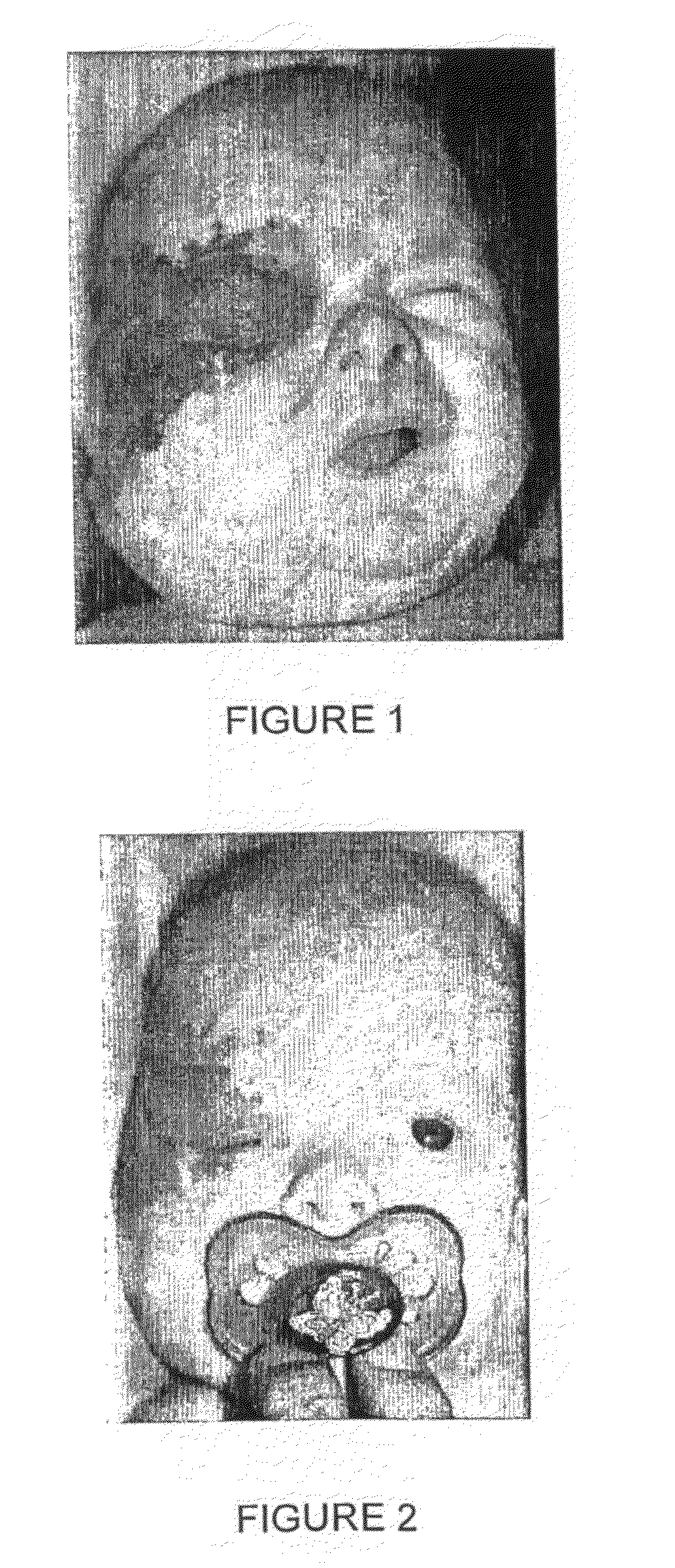 Use of a beta blocker for the manufacture of a medicament for the treatment of hemangiomas