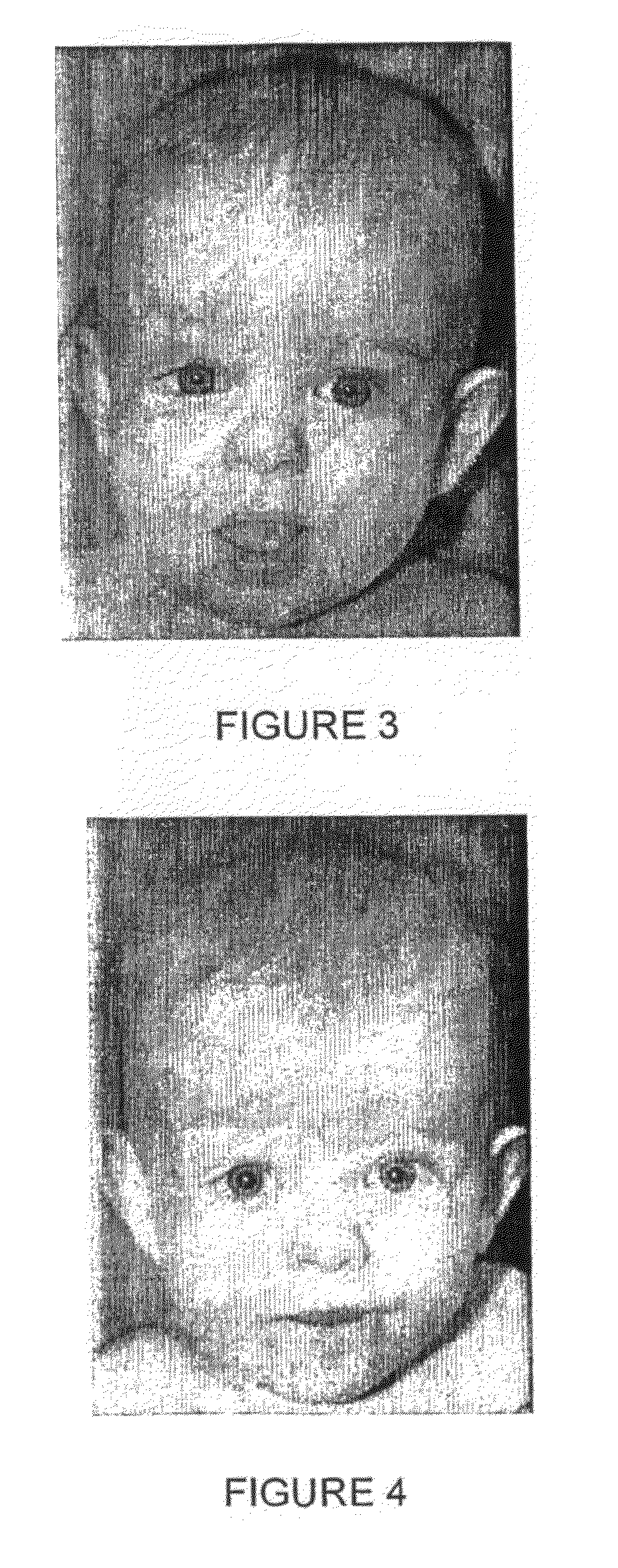 Use of a beta blocker for the manufacture of a medicament for the treatment of hemangiomas