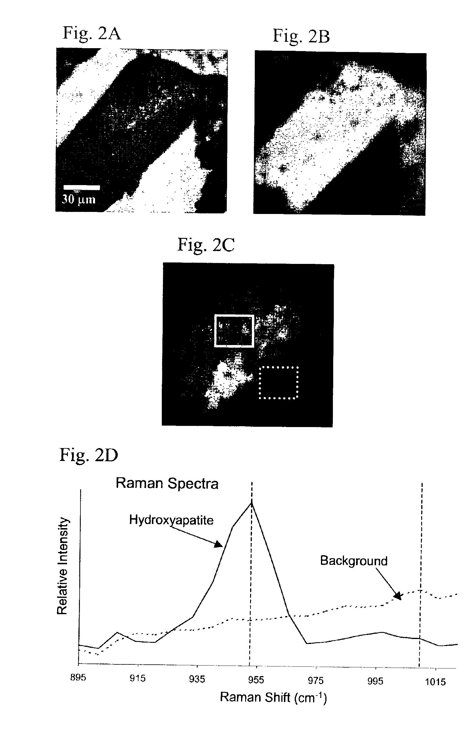 Method for Raman chemical imaging and characterization of calcification in tissue