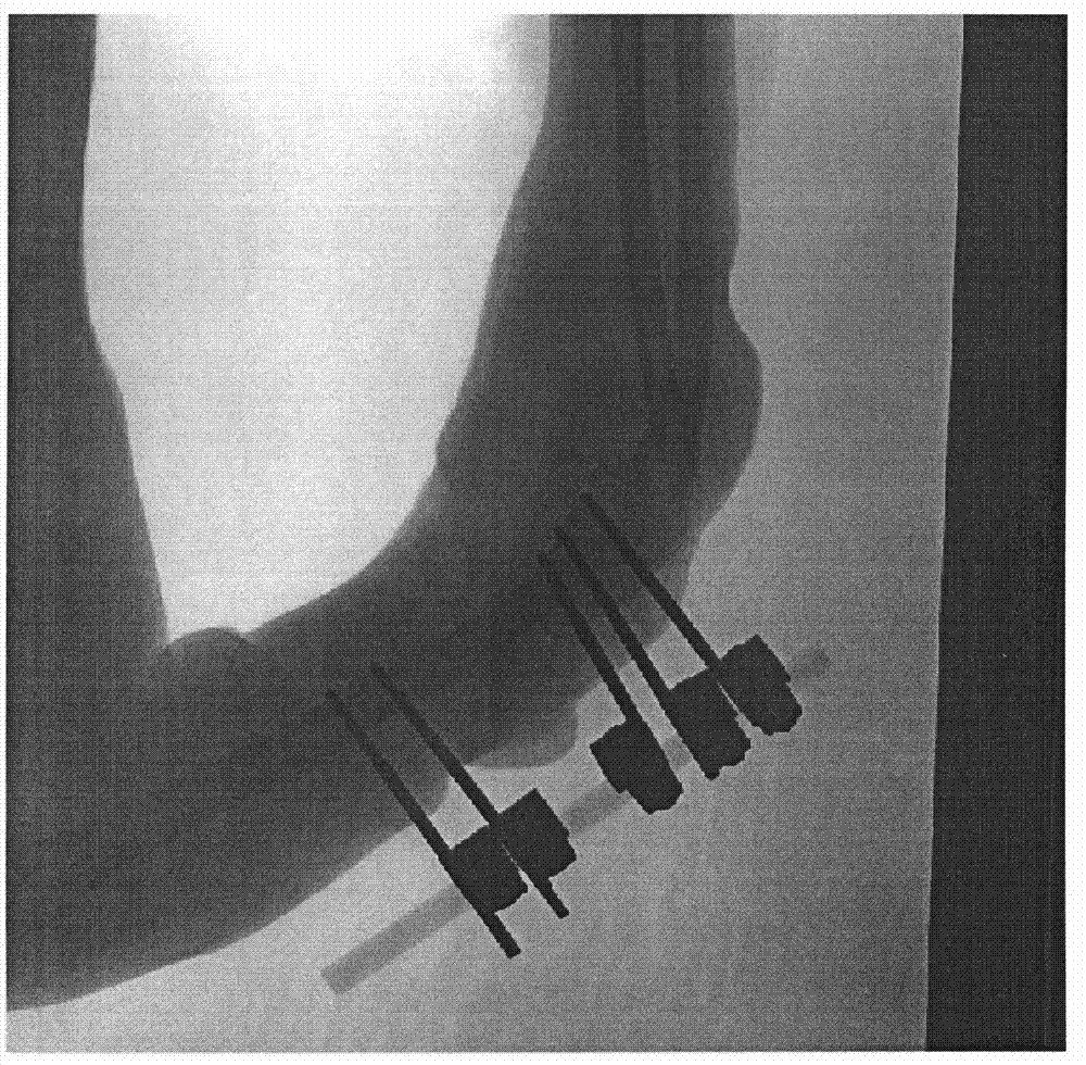 Method and device for extracting metallic foreign body from X-ray image