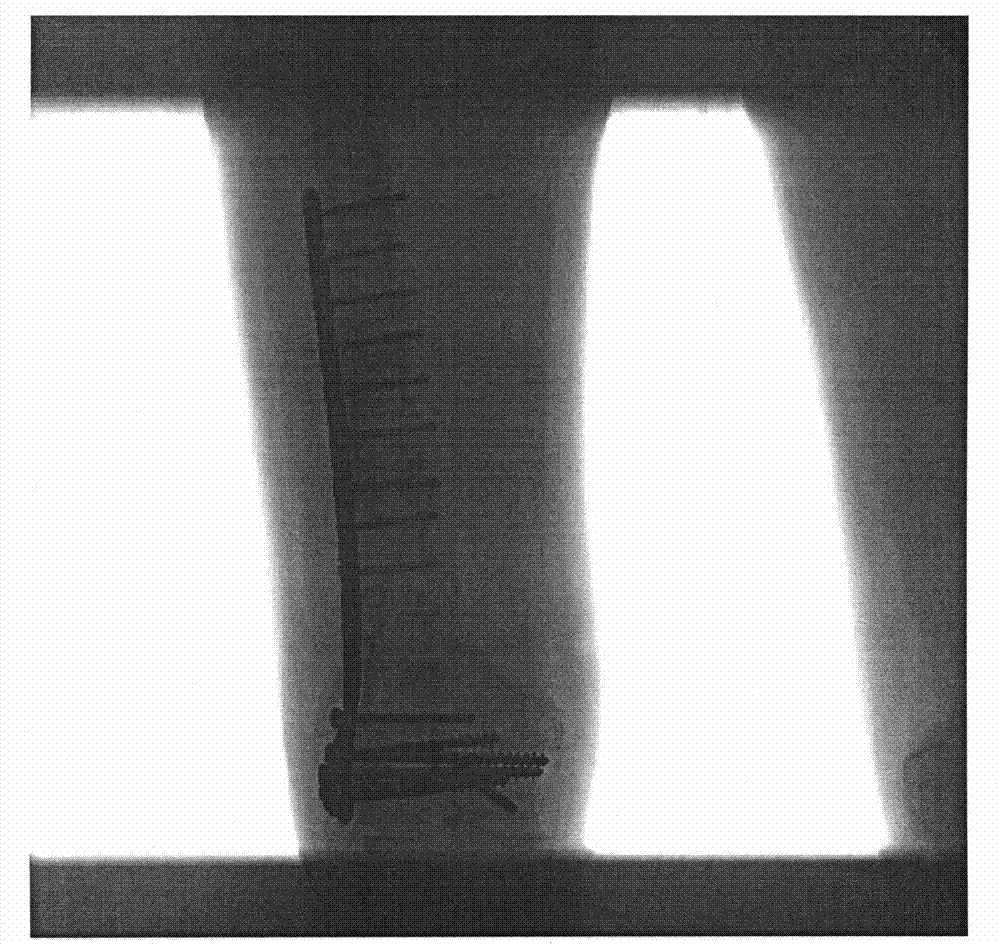 Method and device for extracting metallic foreign body from X-ray image