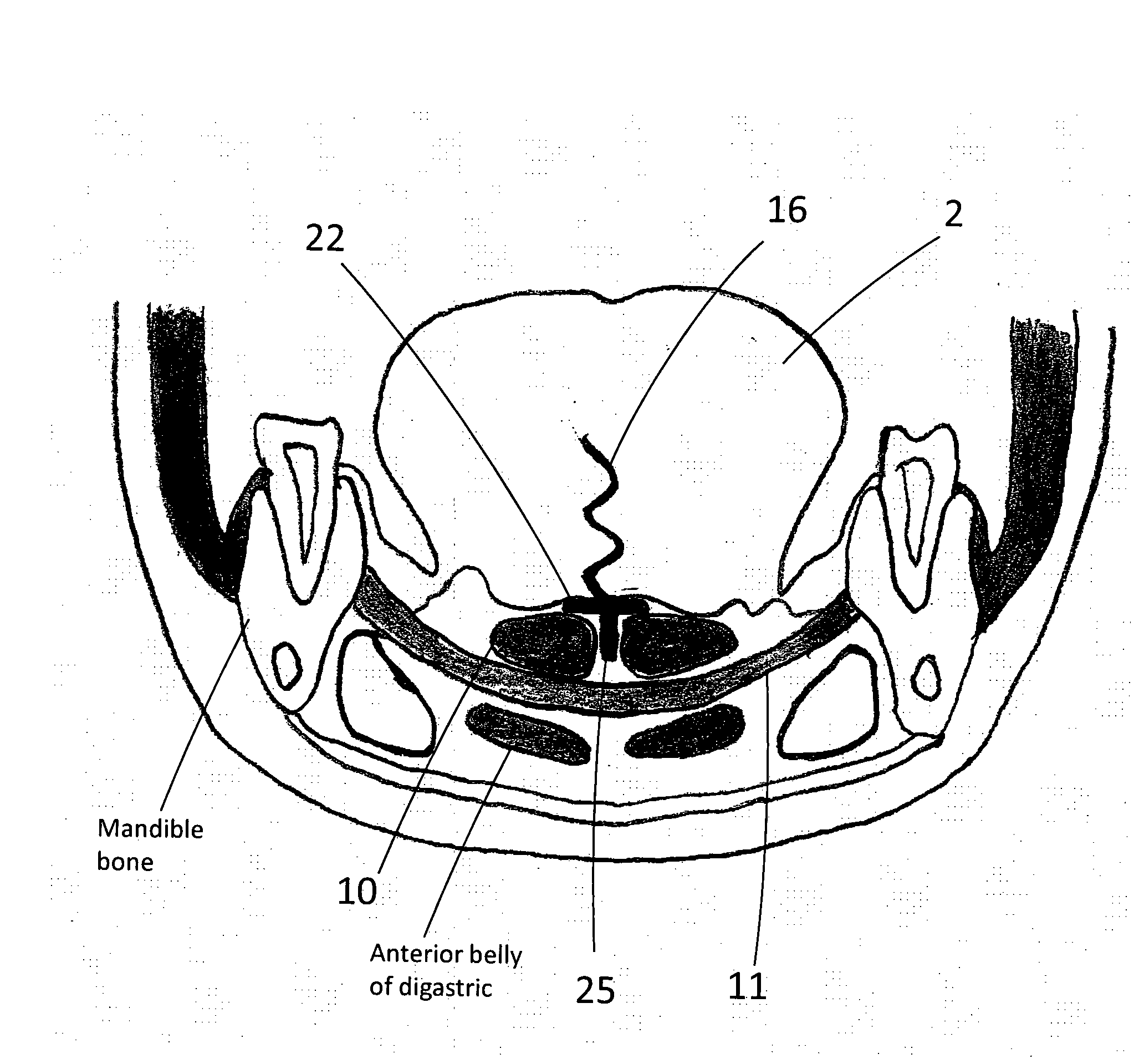 Tongue deformation implant