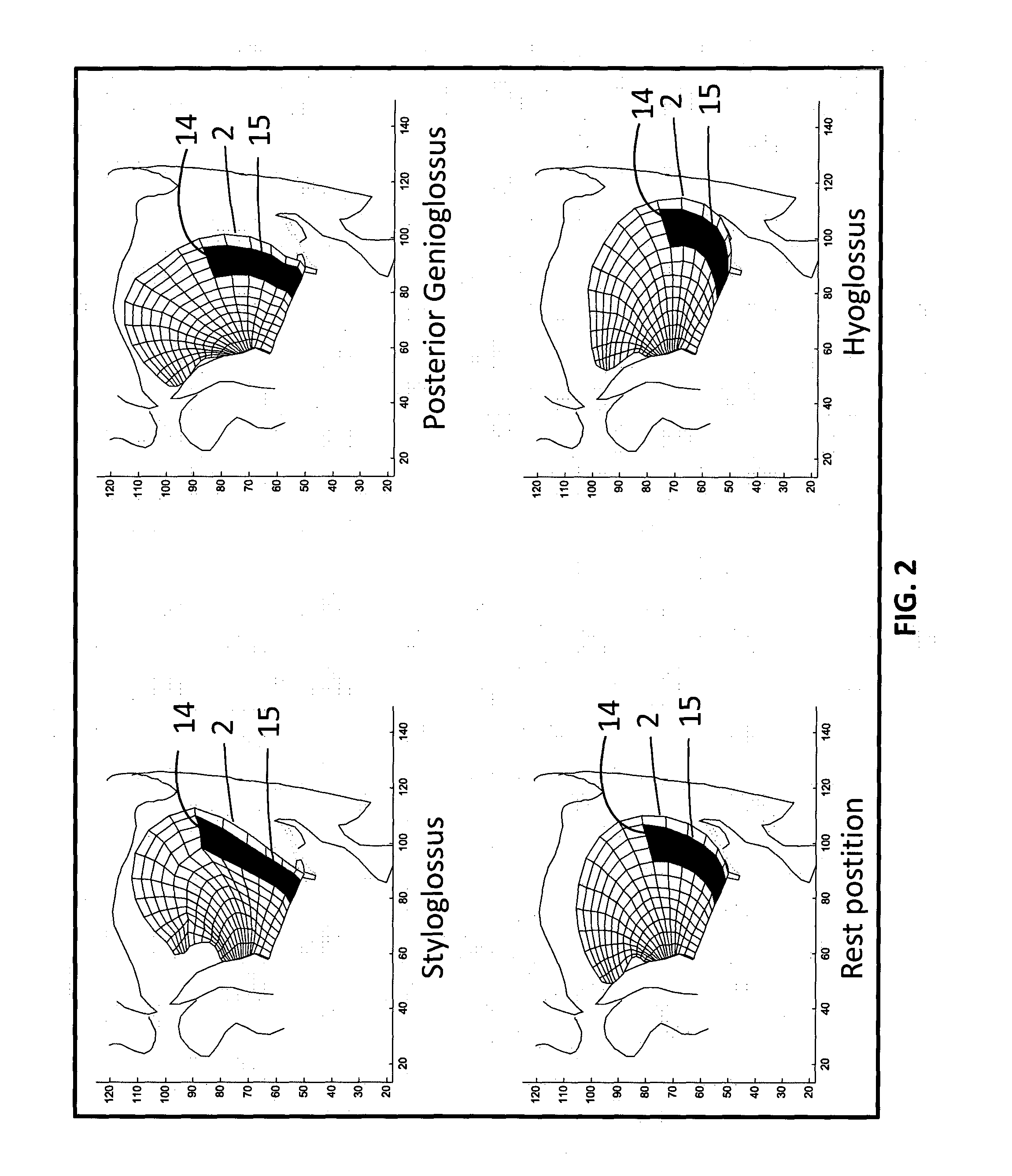 Tongue deformation implant