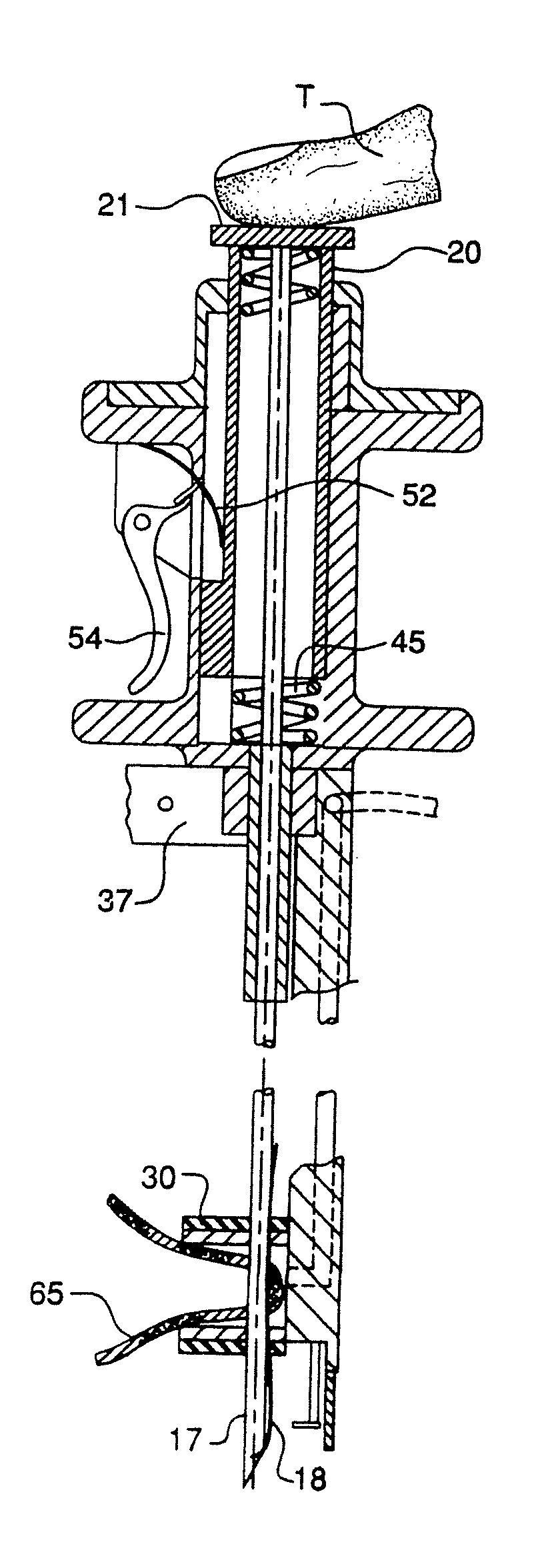 Surgical Instrument for Endoscopic Suturing of Deep Subcutaneous Tissue