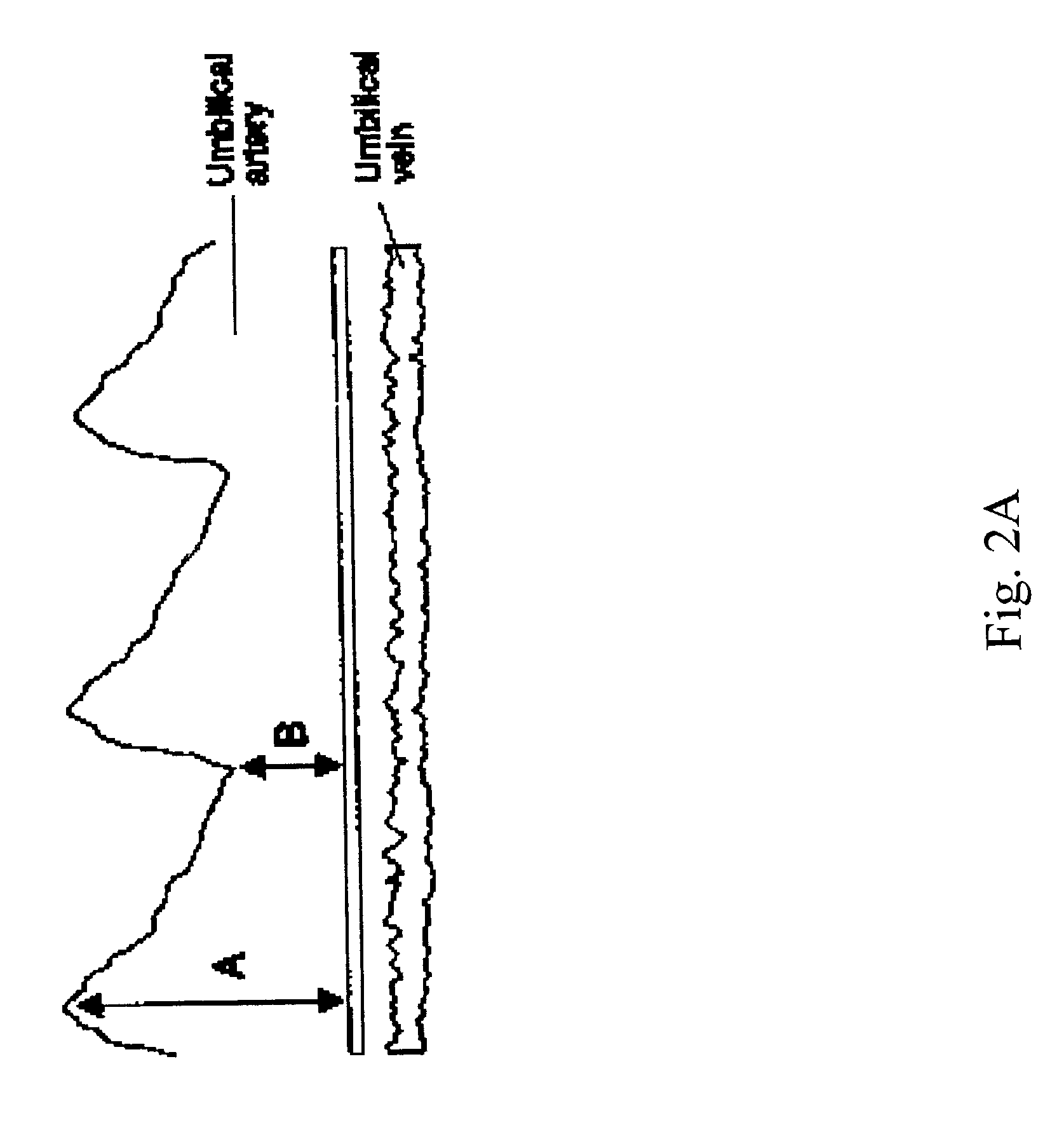 Use of digoxin immune Fab (ovine) for the regulation of sodium/potassium ATPase activity in preeclamptic and eclamptic patients