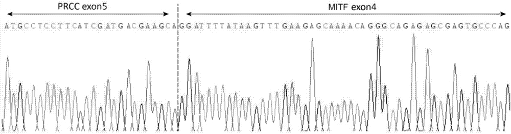 Novel fusion gene for MiT familial translocation renal cell carcinoma and detection primer and application of novel fusion gene