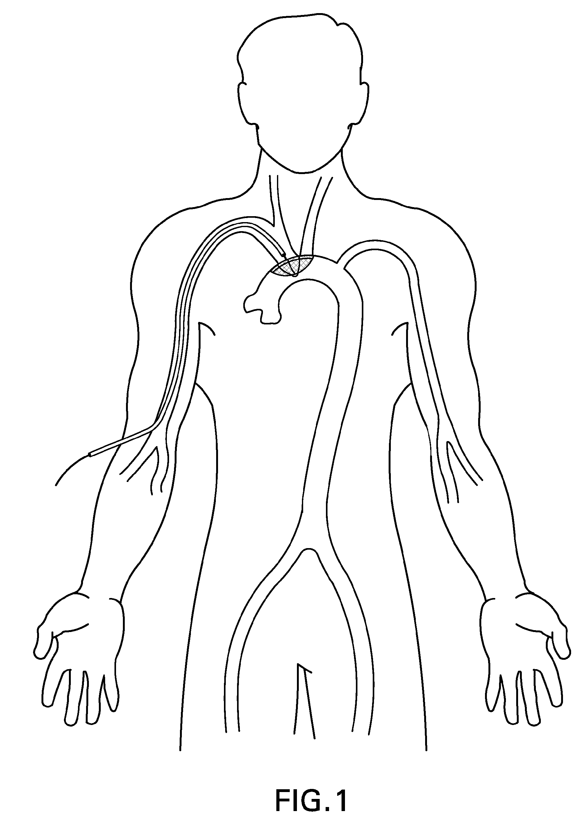 Embolic Protection Device and Method of Use