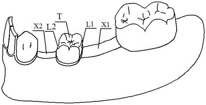 Deciduous tooth interval loss space restoring and maintaining method