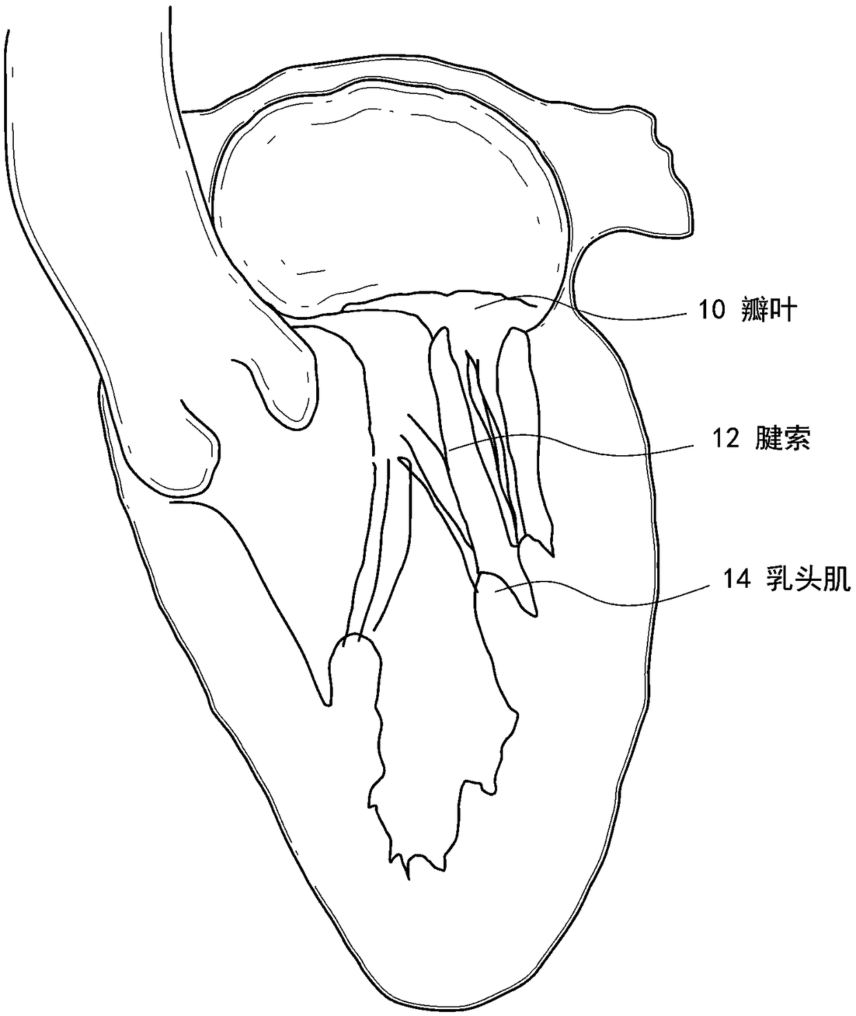 Mitral leaflet tethering