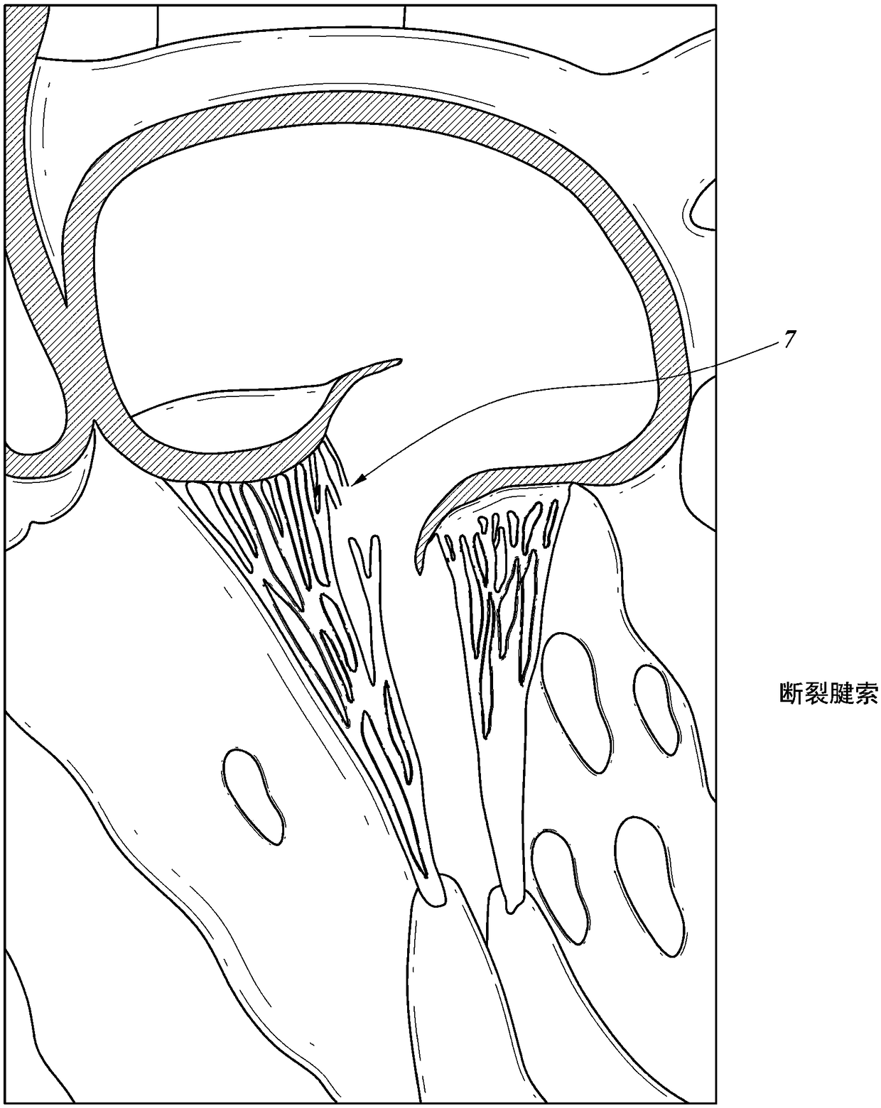 Mitral leaflet tethering