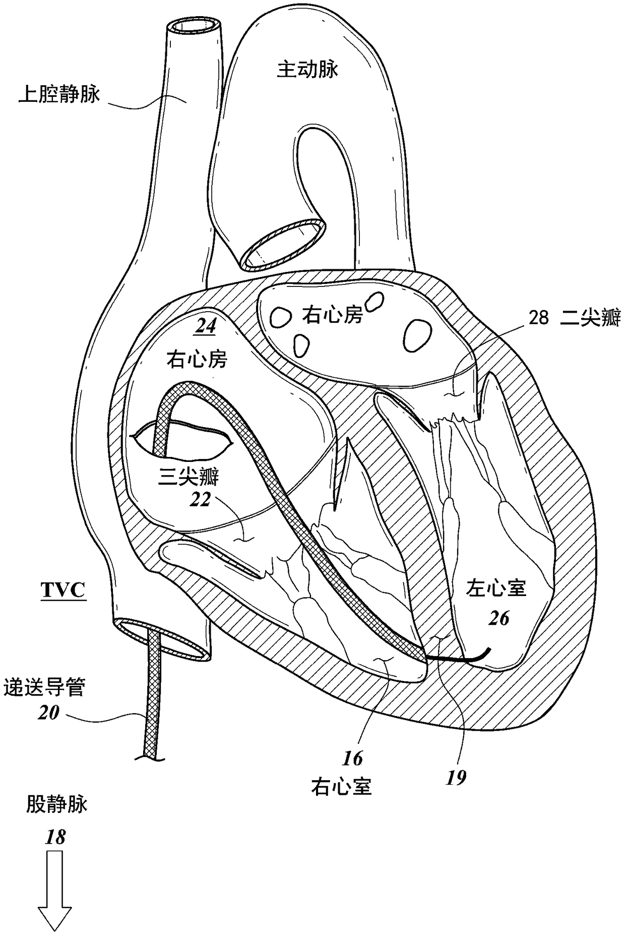 Mitral leaflet tethering