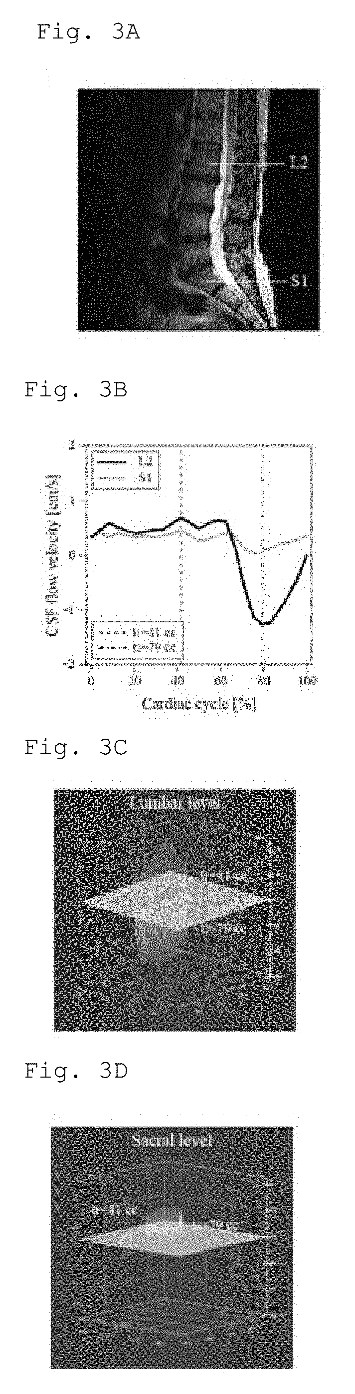 Method and apparatus for diagnosing lumbar spinal stenosis