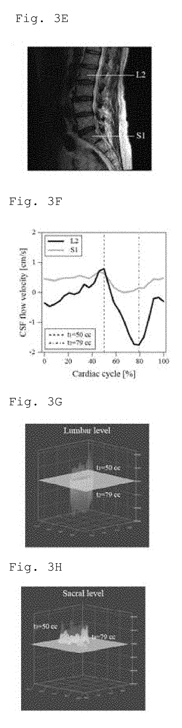 Method and apparatus for diagnosing lumbar spinal stenosis