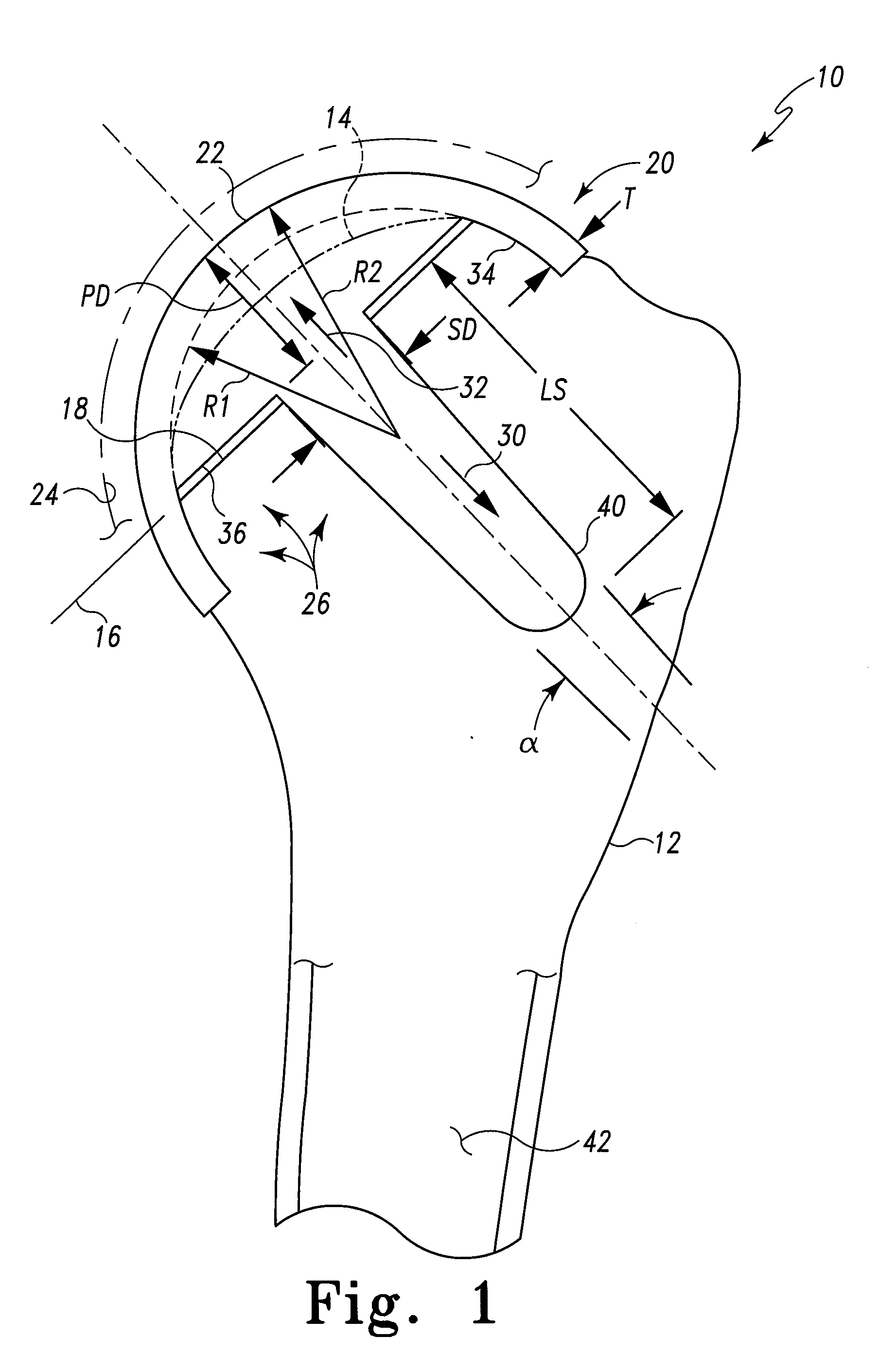 Articulating Surface Replacement Prosthesis