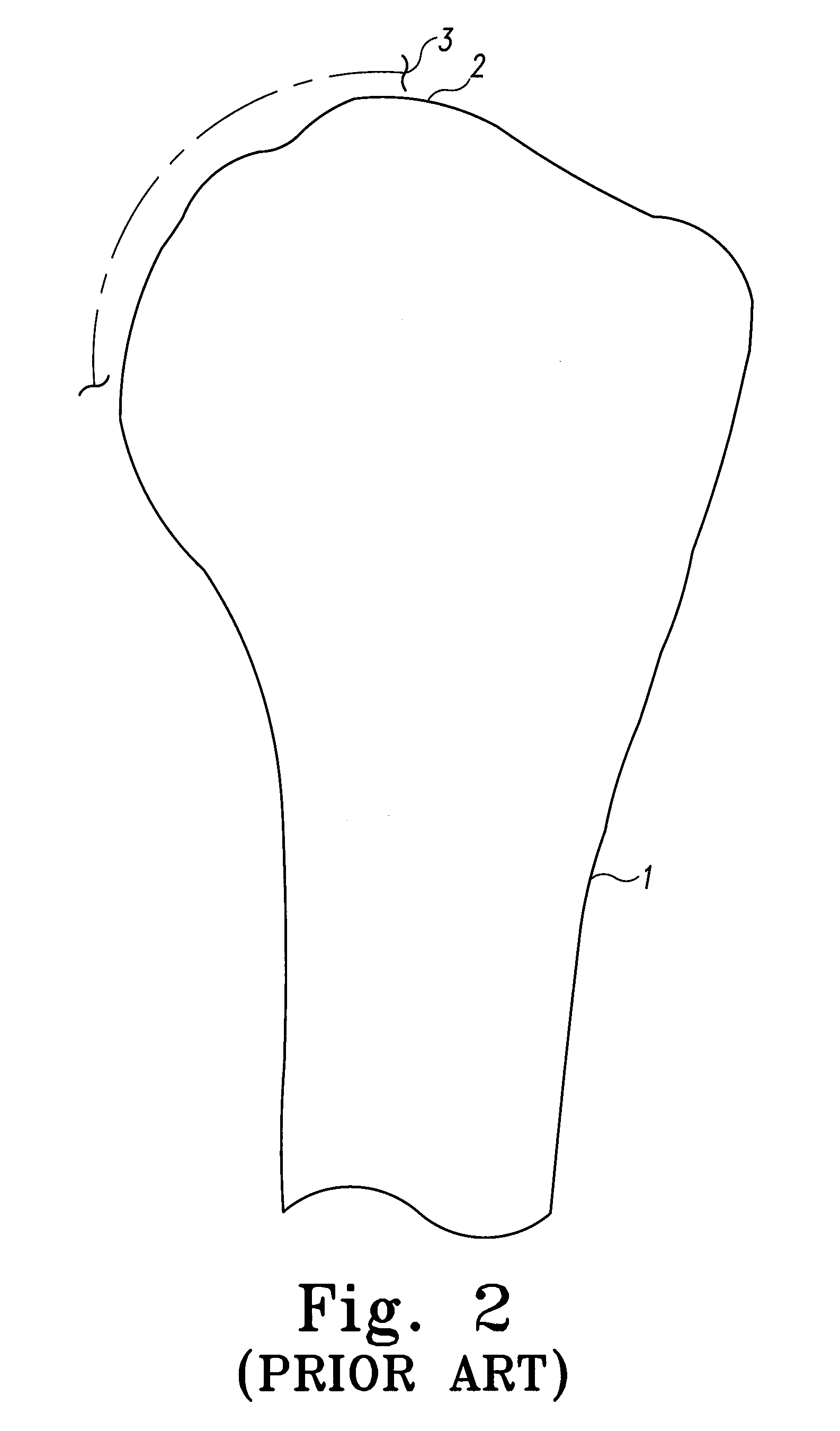 Articulating Surface Replacement Prosthesis