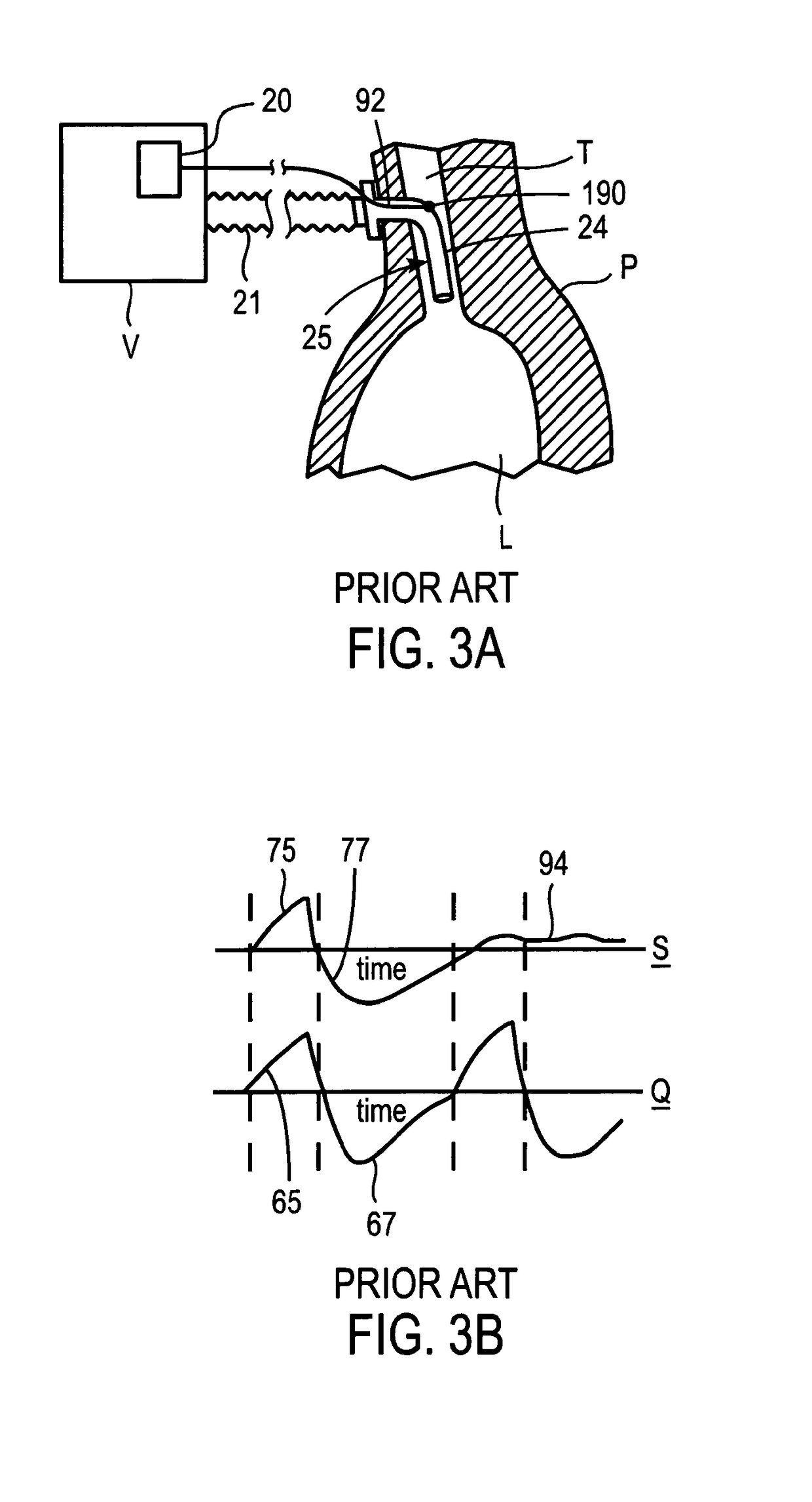 Methods and devices for sensing respiration and providing ventilation therapy