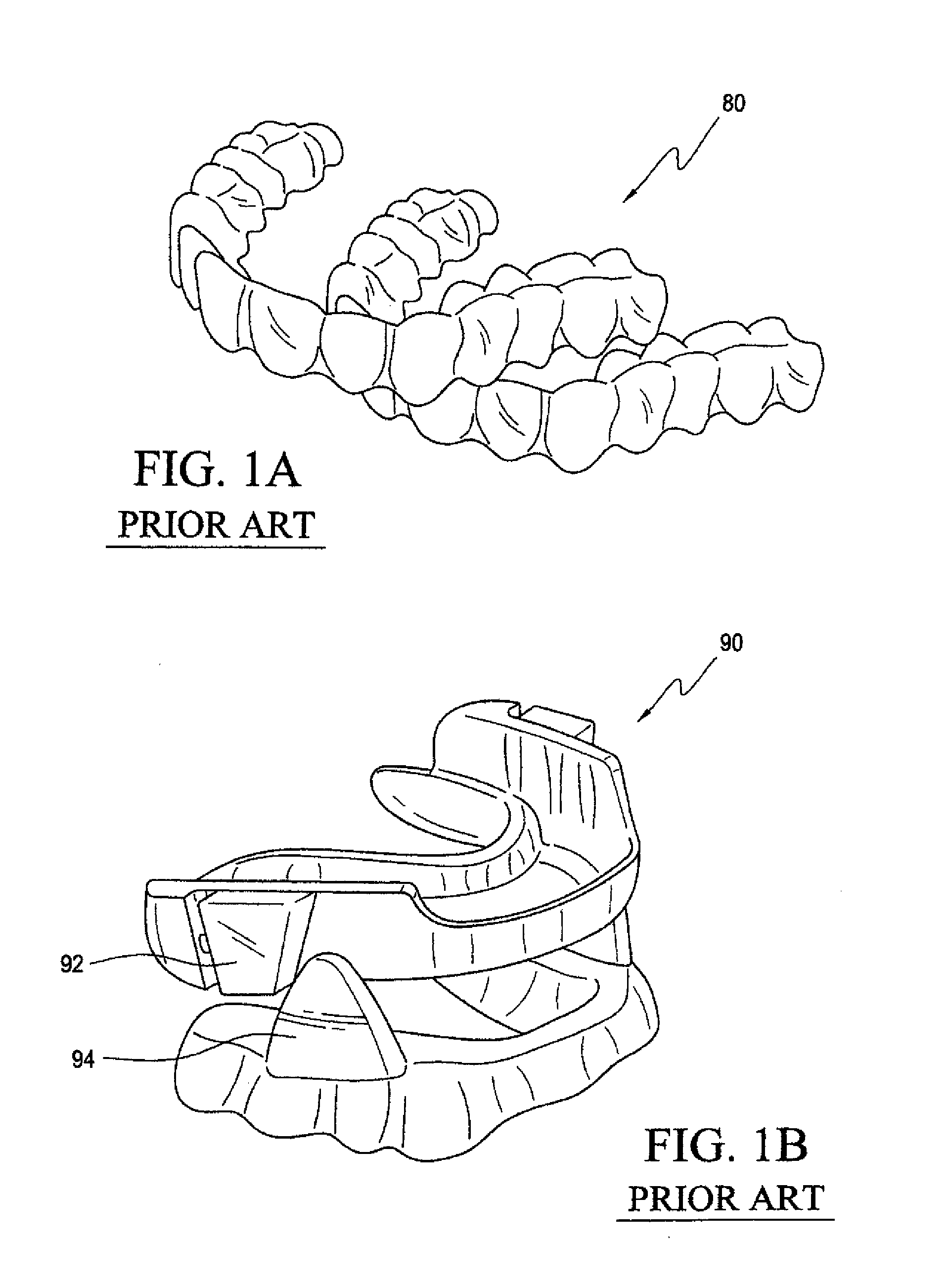 System and Method for Treating Obstructive Sleep Apnea and Correcting Malocclusion Simultaneously