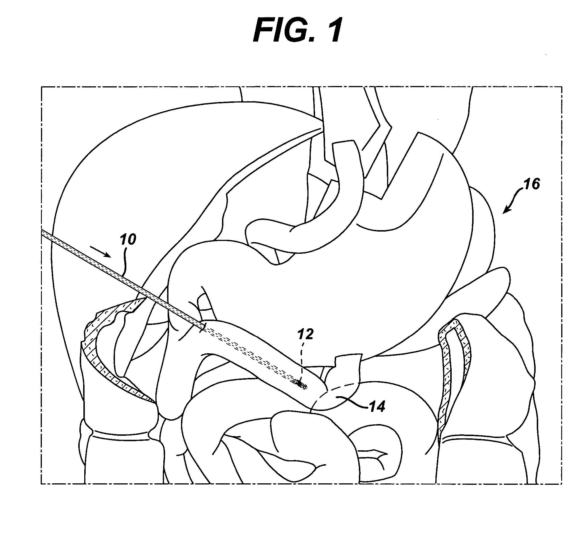 Single lumen anastomosis applier for self-deploying fastener