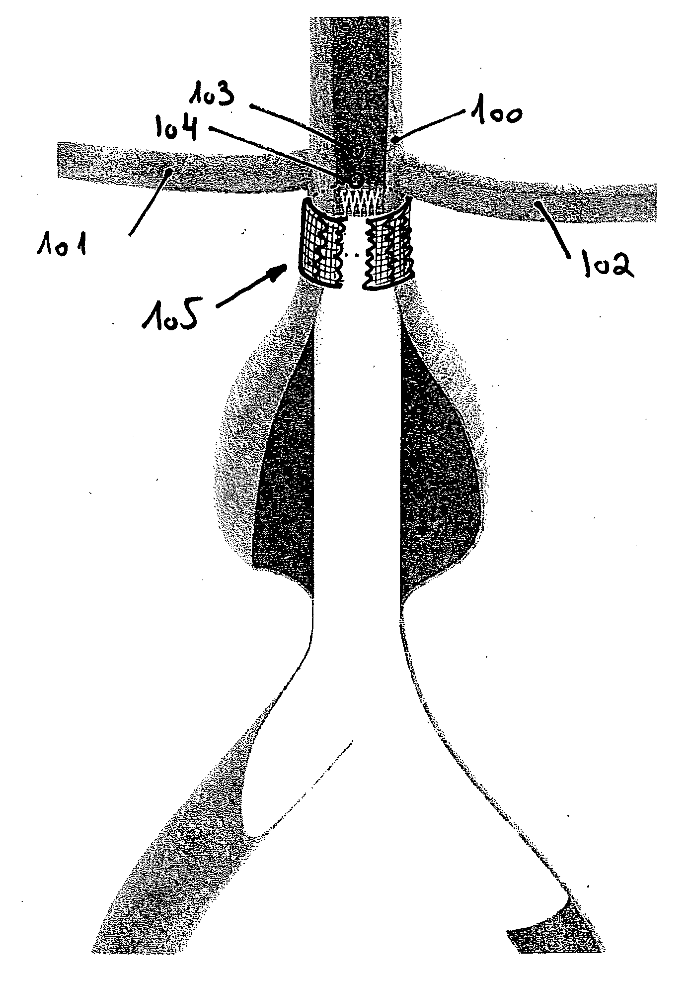Extra-Vascular Wrapping for Treating Aneurysmatic Aorta in Conjunction with Endovascular Stent-Graft and Methods Thereof
