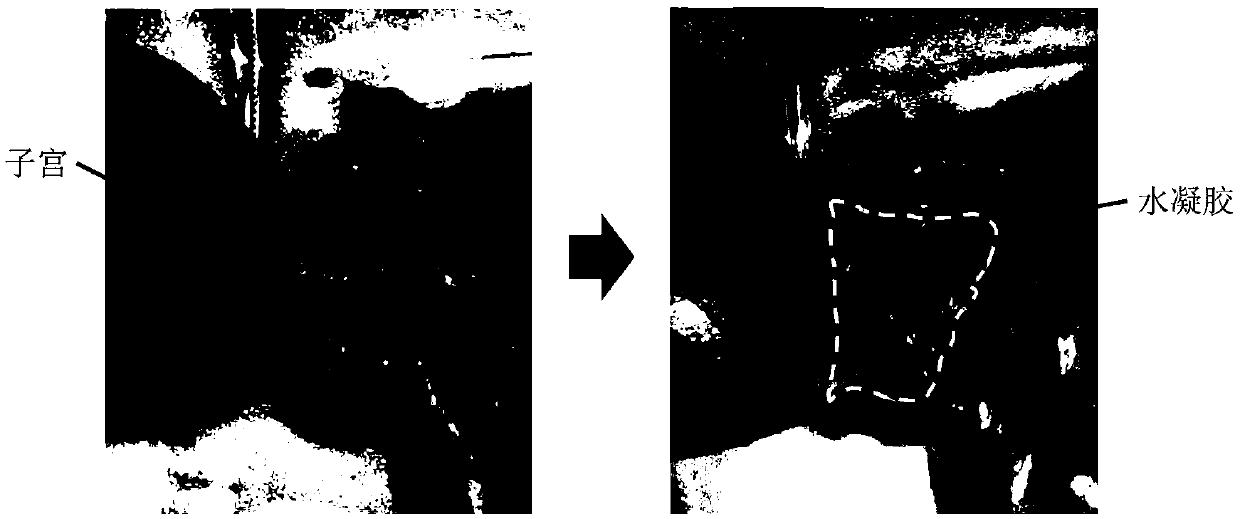 Medical hydrogel with radiation prevention effect