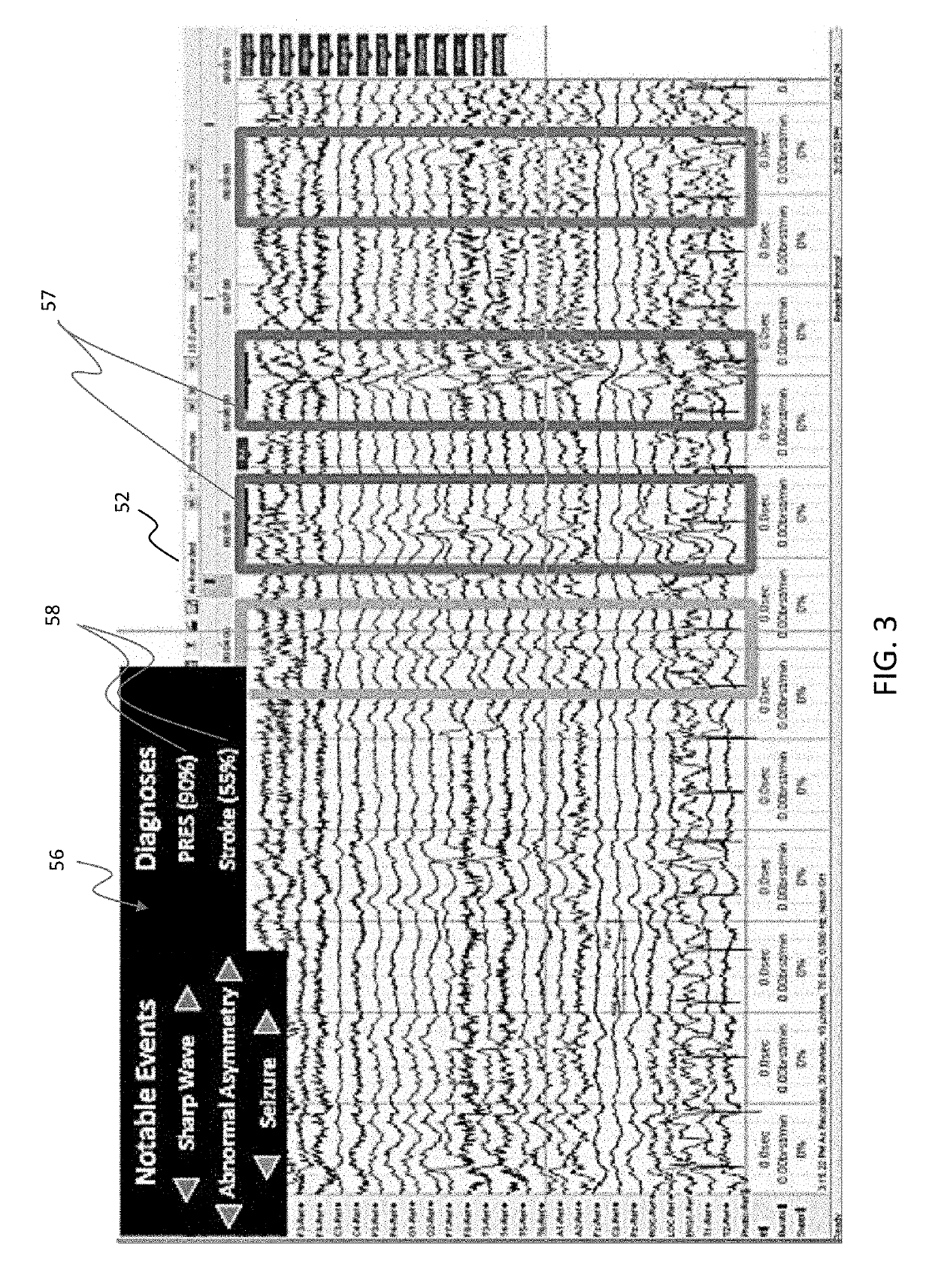 System and Method for Automatic Interpretation of EEG Signals Using a Deep Learning Statistical Model