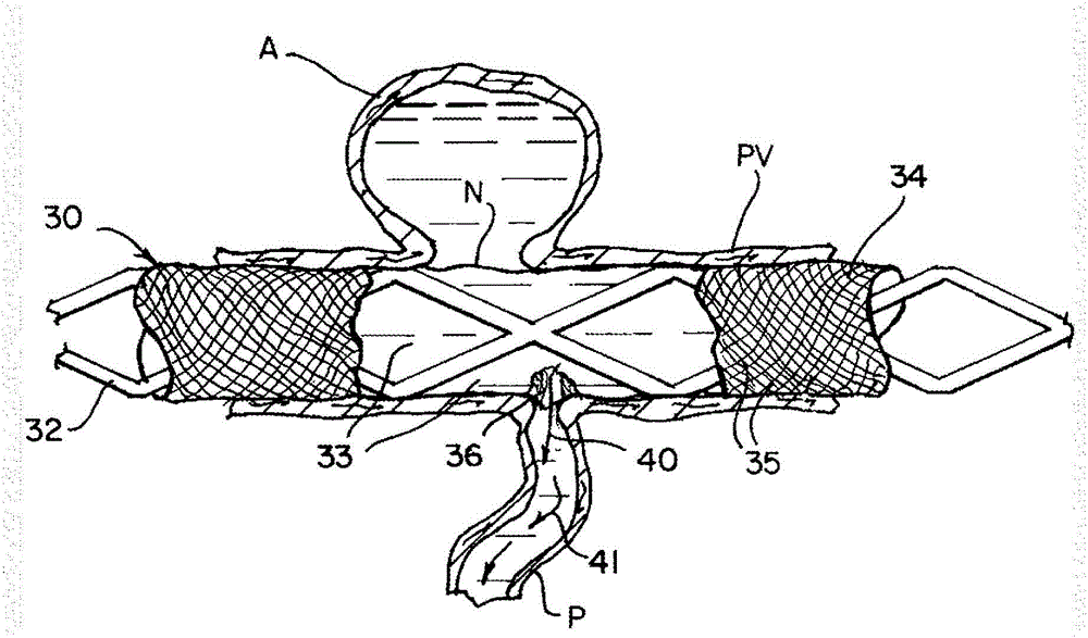 Improved modifiable occlusion device