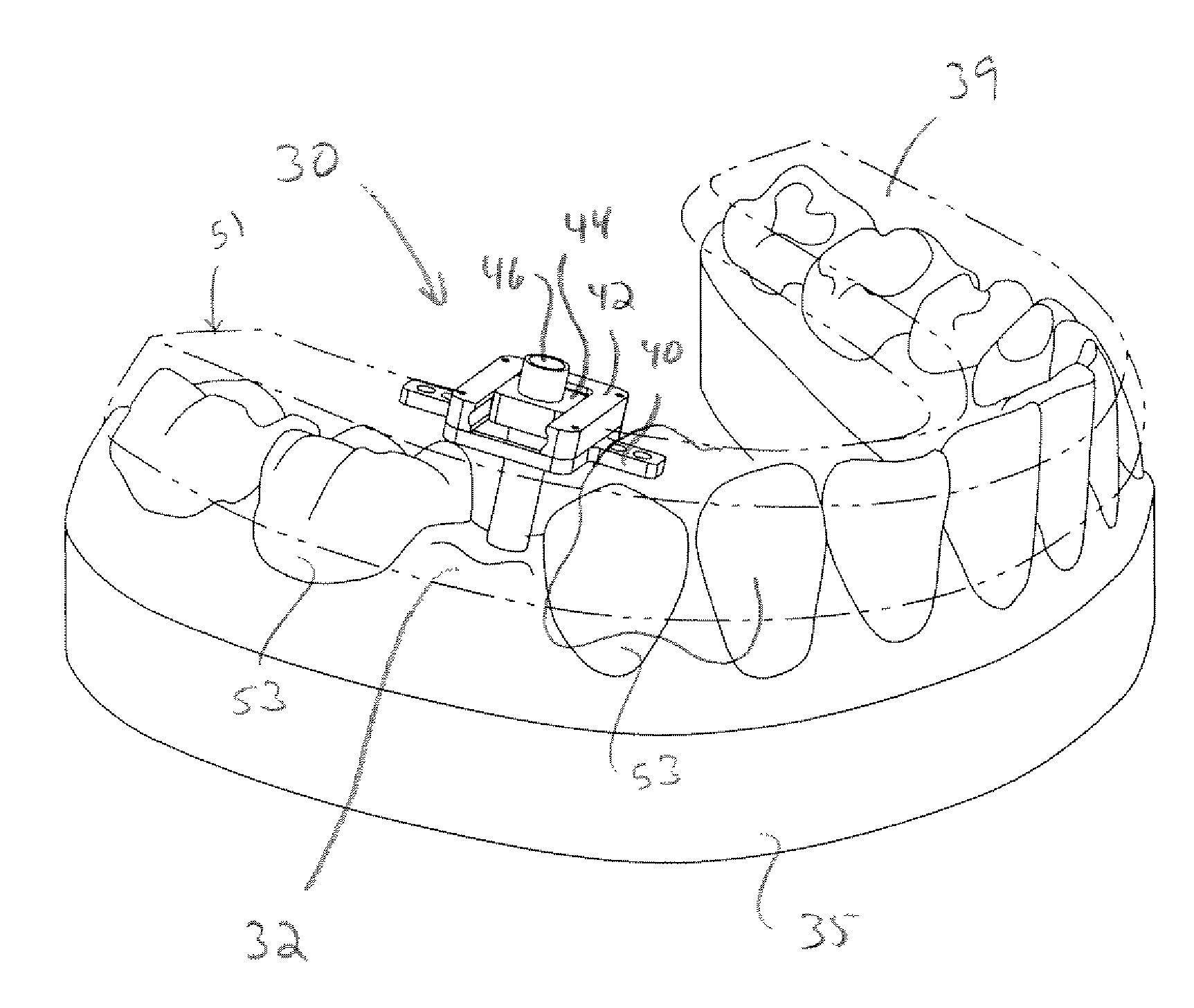 Surgical guide for dental implant and methods therefor