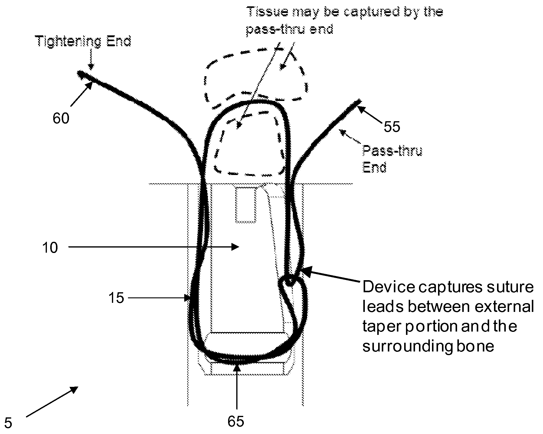 Method and apparatus for securing soft tissue to bone