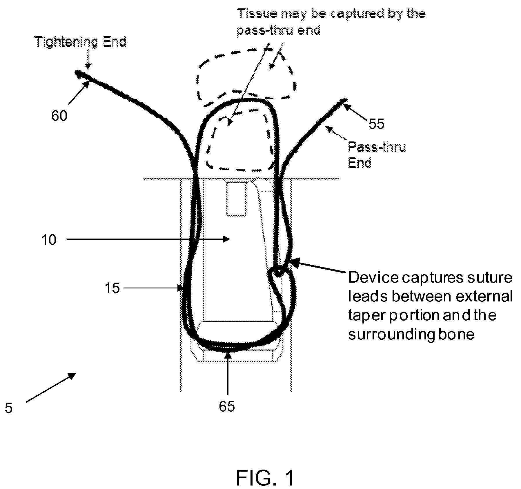 Method and apparatus for securing soft tissue to bone