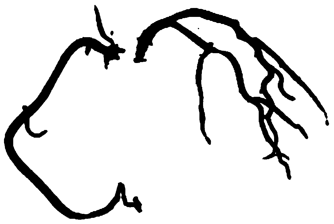 A fully automatic coronary artery segmentation method