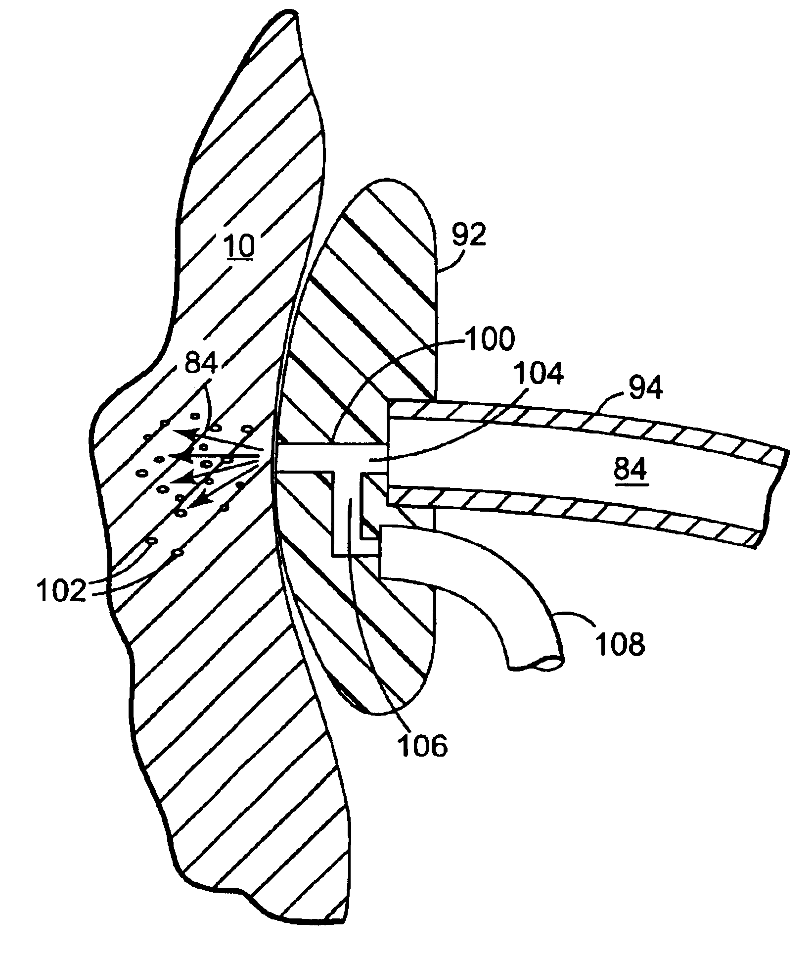 Method of injecting a drug and echogenic bubbles into prostate tissue