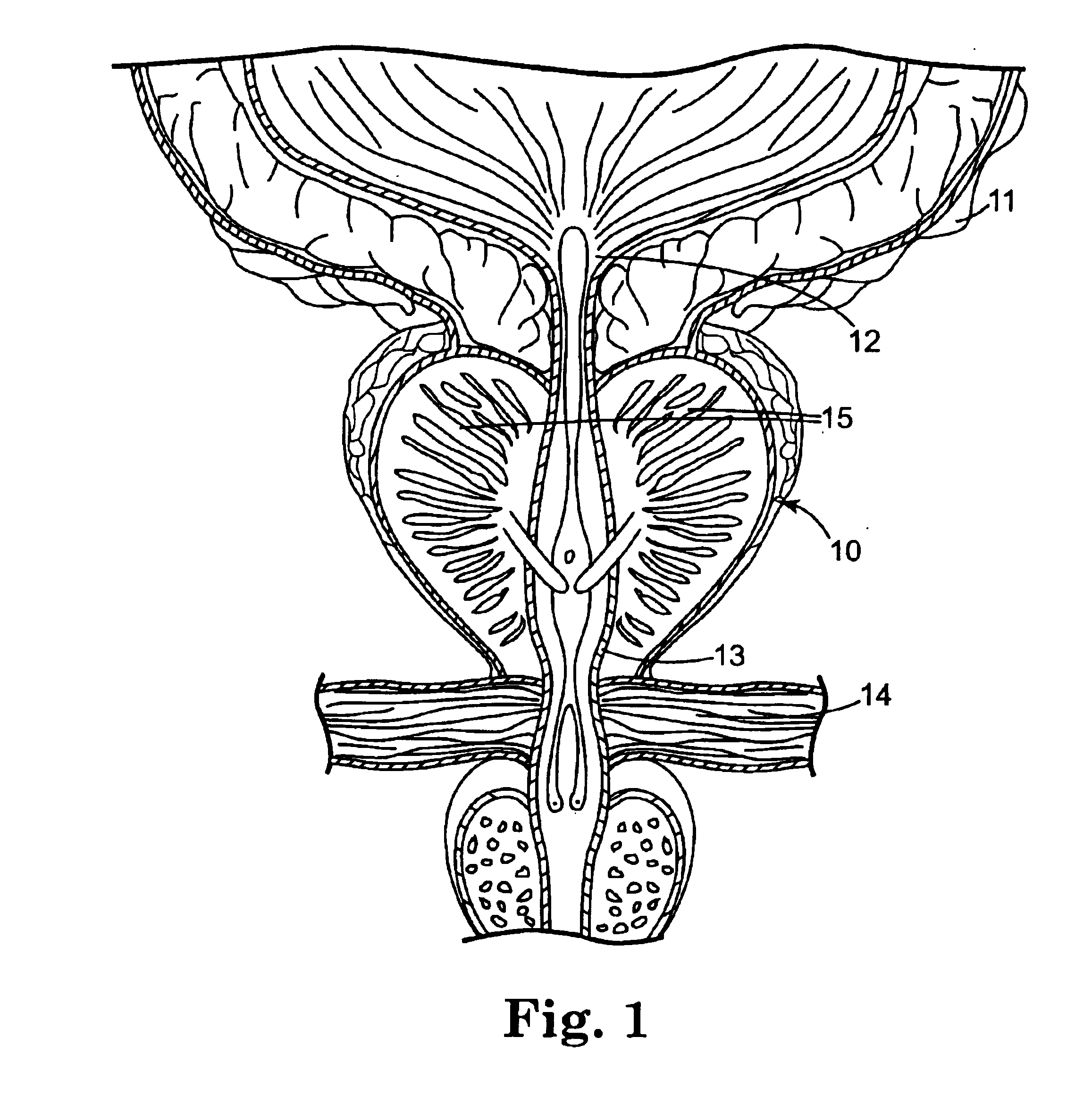 Method of injecting a drug and echogenic bubbles into prostate tissue