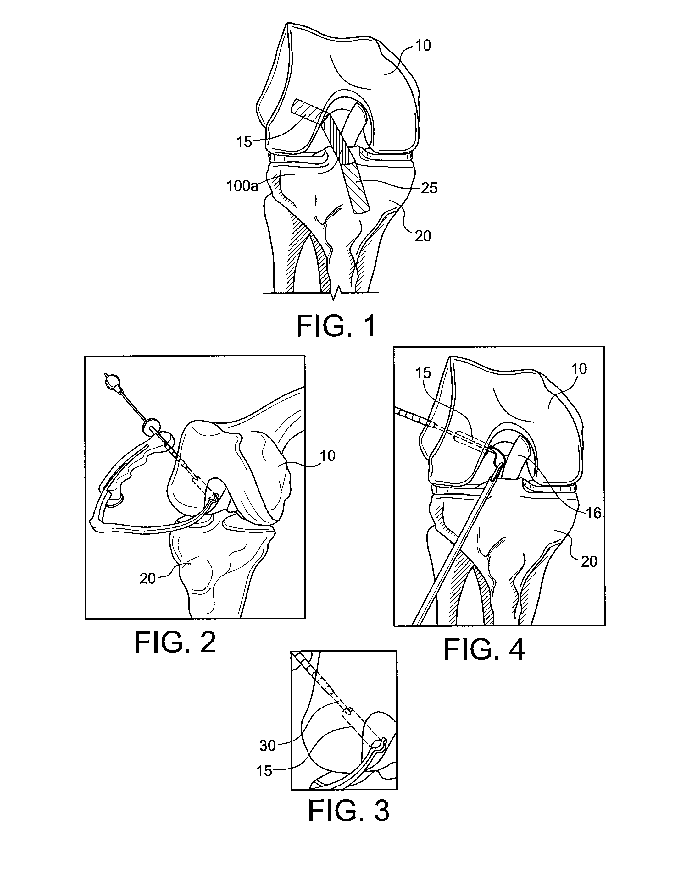 Methods and systems for forming unicompartmental and unicondylar knee resurfacing in conjunction with cruciate ligament replacement concomitantly