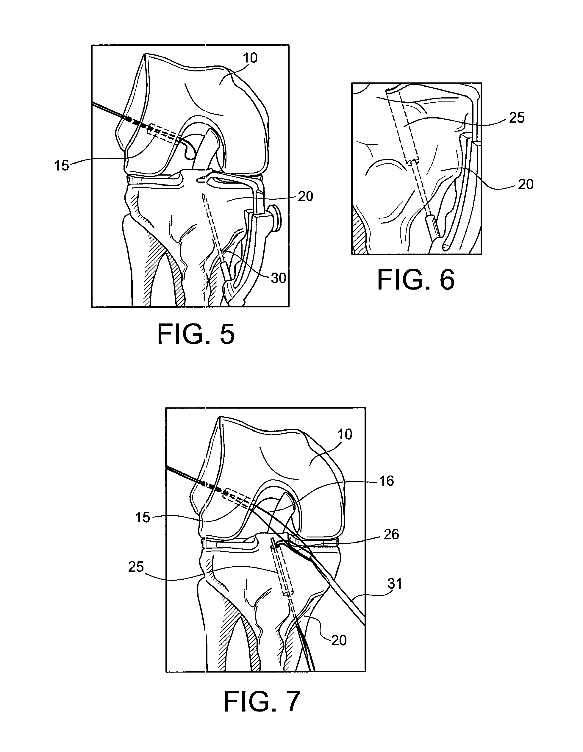 Methods and systems for forming unicompartmental and unicondylar knee resurfacing in conjunction with cruciate ligament replacement concomitantly