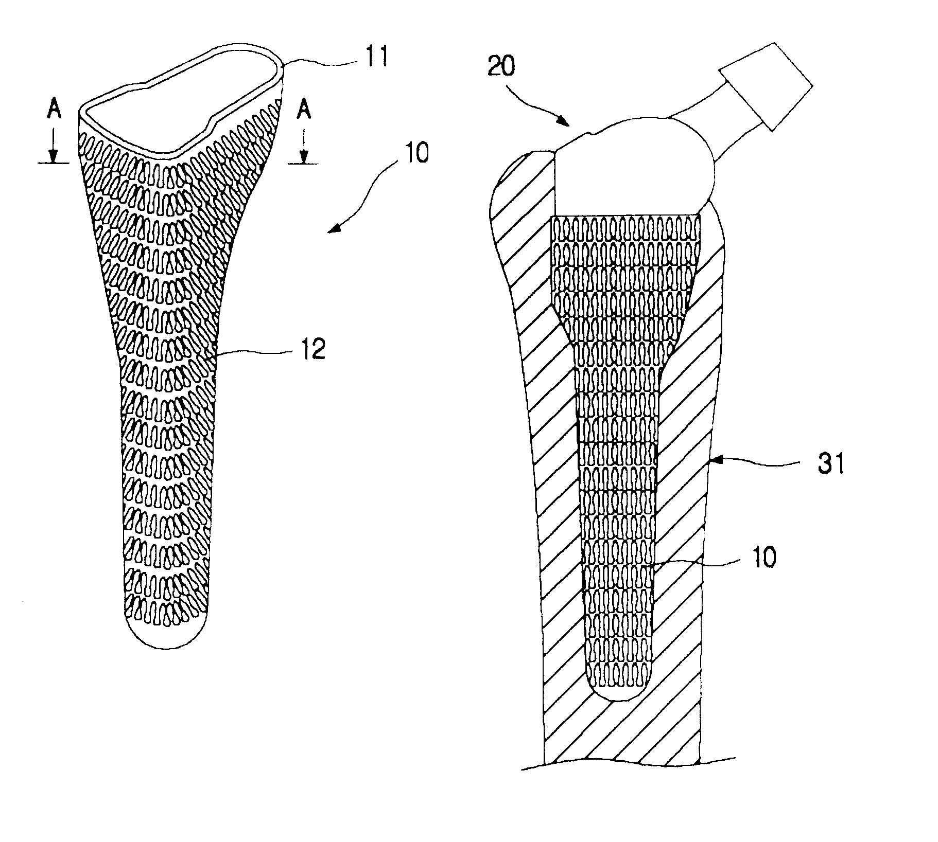 Metal jacket for a cementless artificial joint stem and artificial joint having the jacket