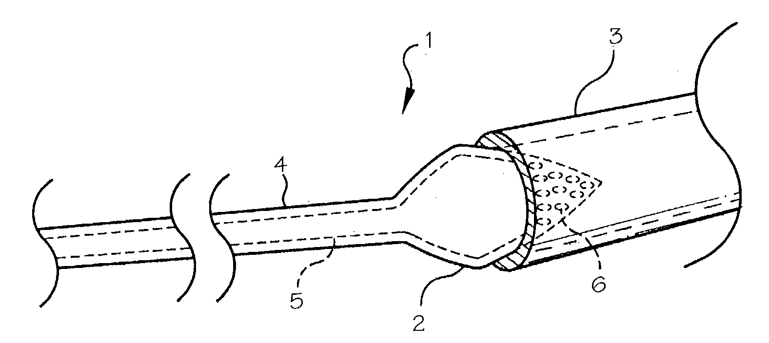 Pulmonary vein arrhythmia diagnostic device and method for use