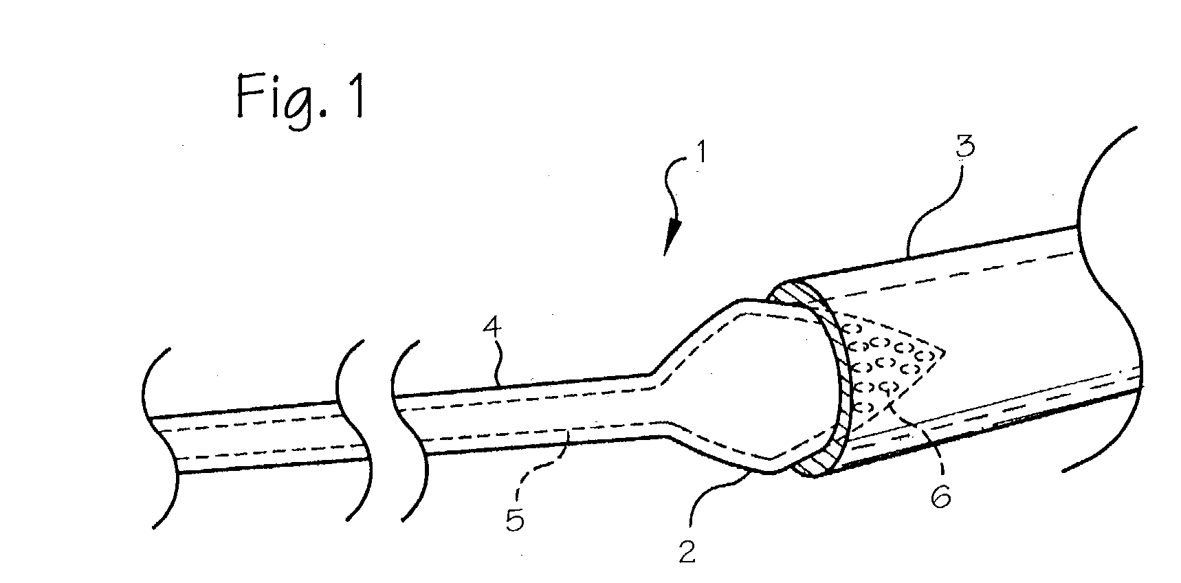 Pulmonary vein arrhythmia diagnostic device and method for use