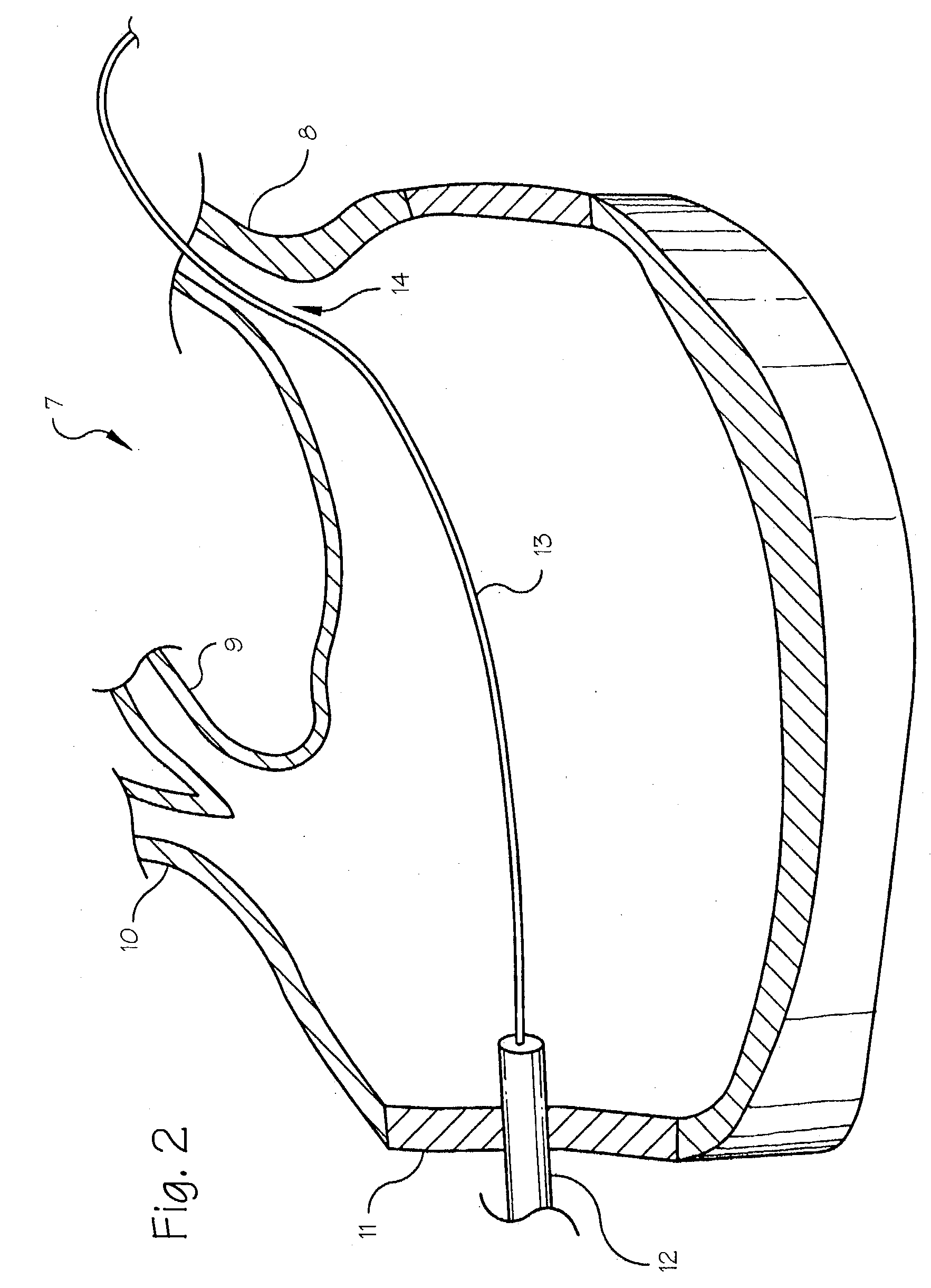 Pulmonary vein arrhythmia diagnostic device and method for use