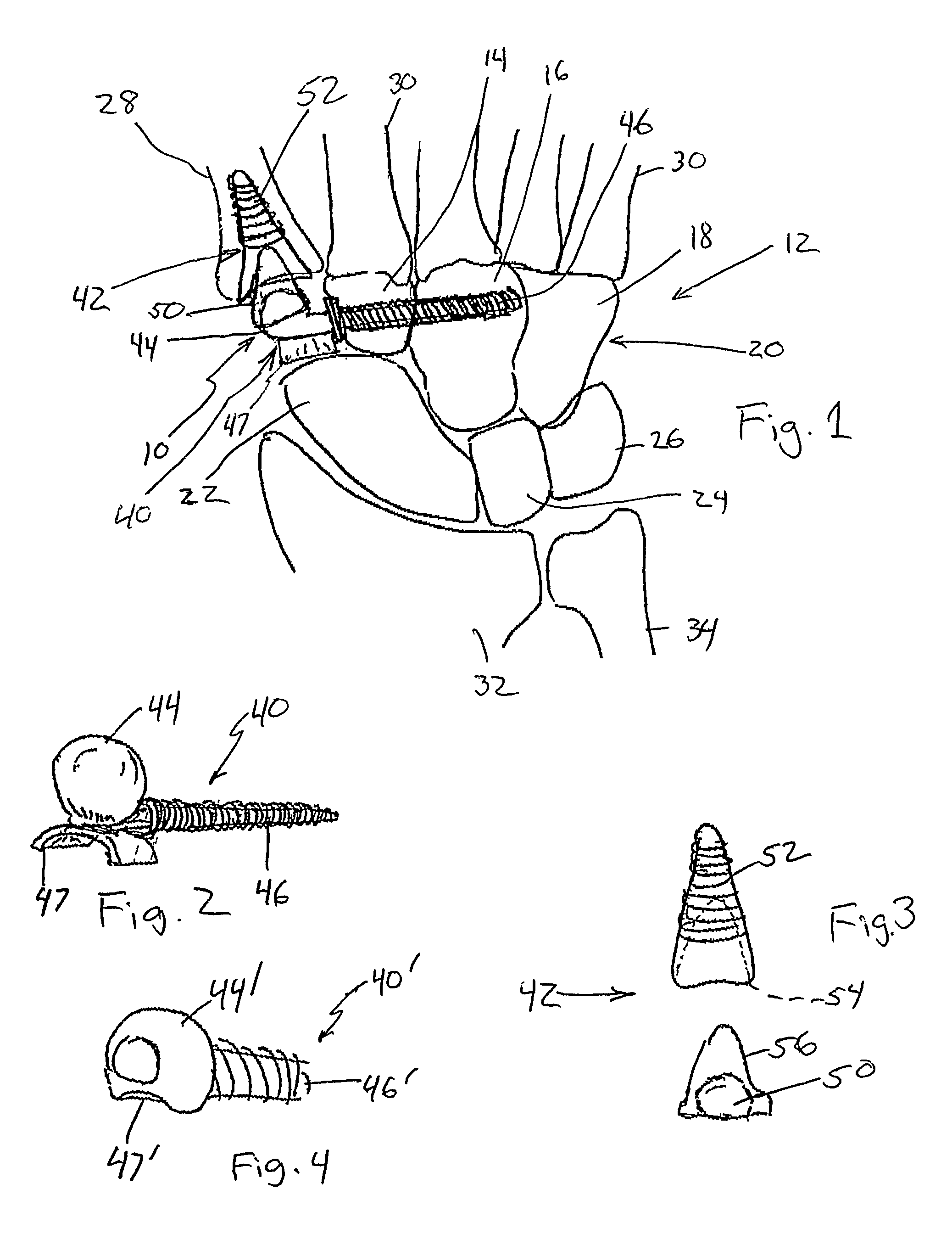 Semi-constrained 1st carpometacarpal implant arthroplasty and method