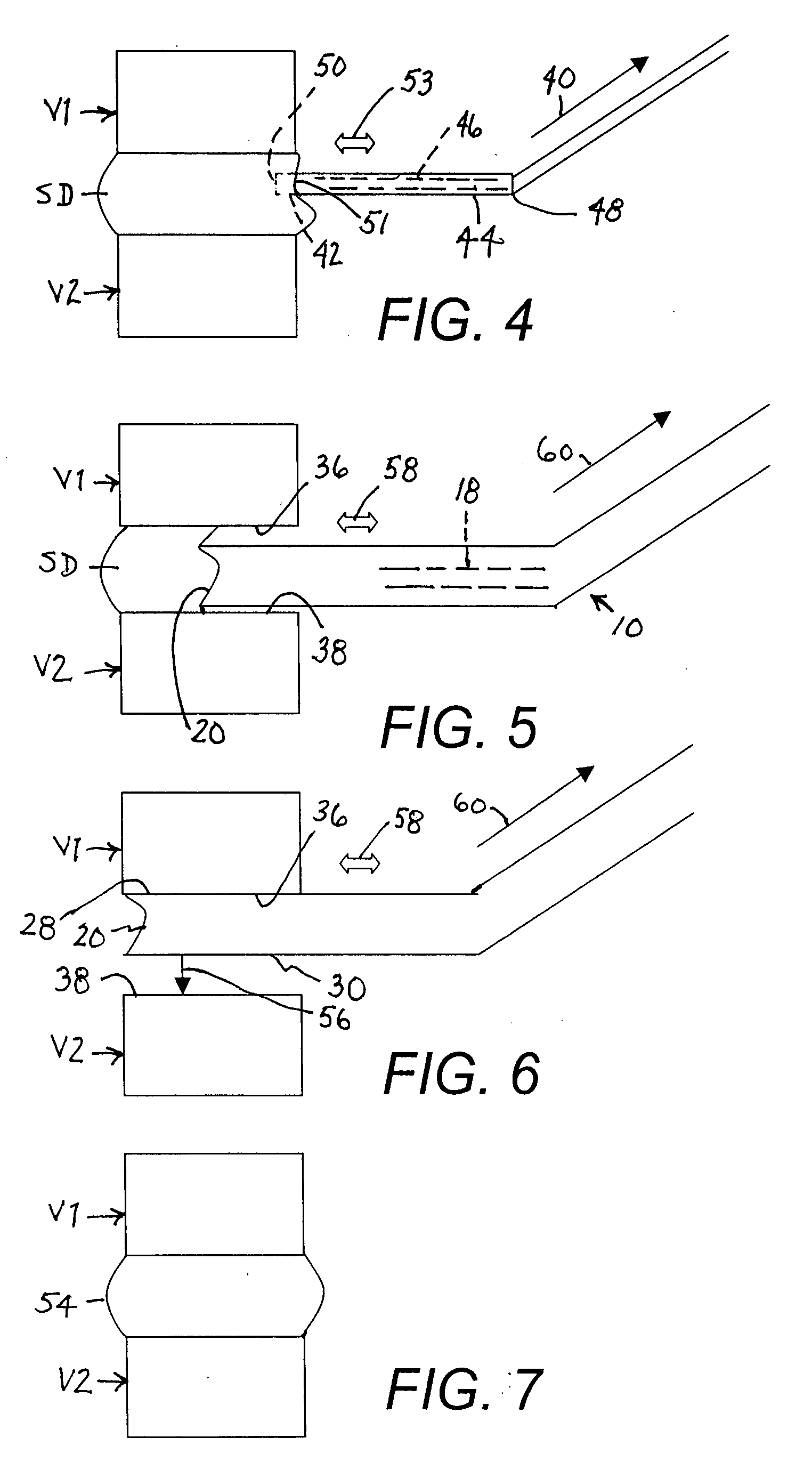 Ultrasonic spinal surgery method