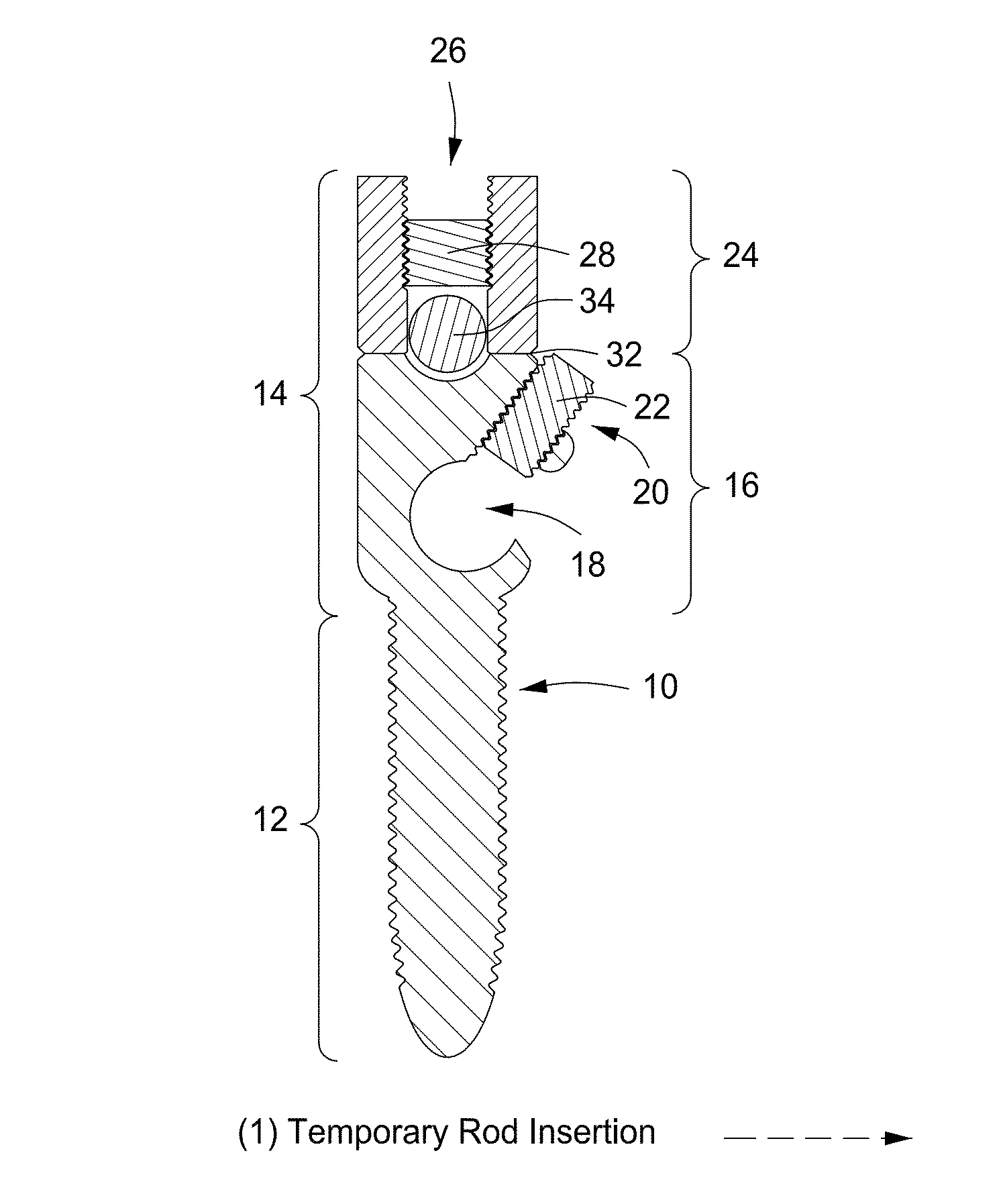 Pedicle screw having a removable rod coupling