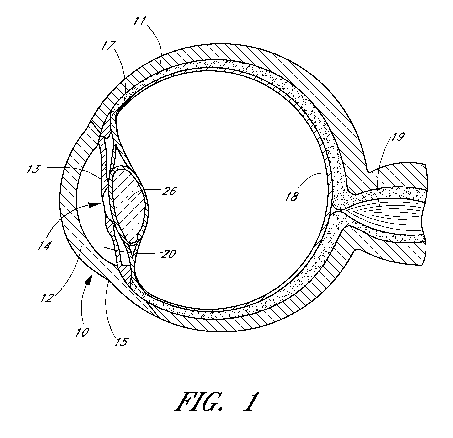 Ocular implant with anchoring mechanism and multiple outlets