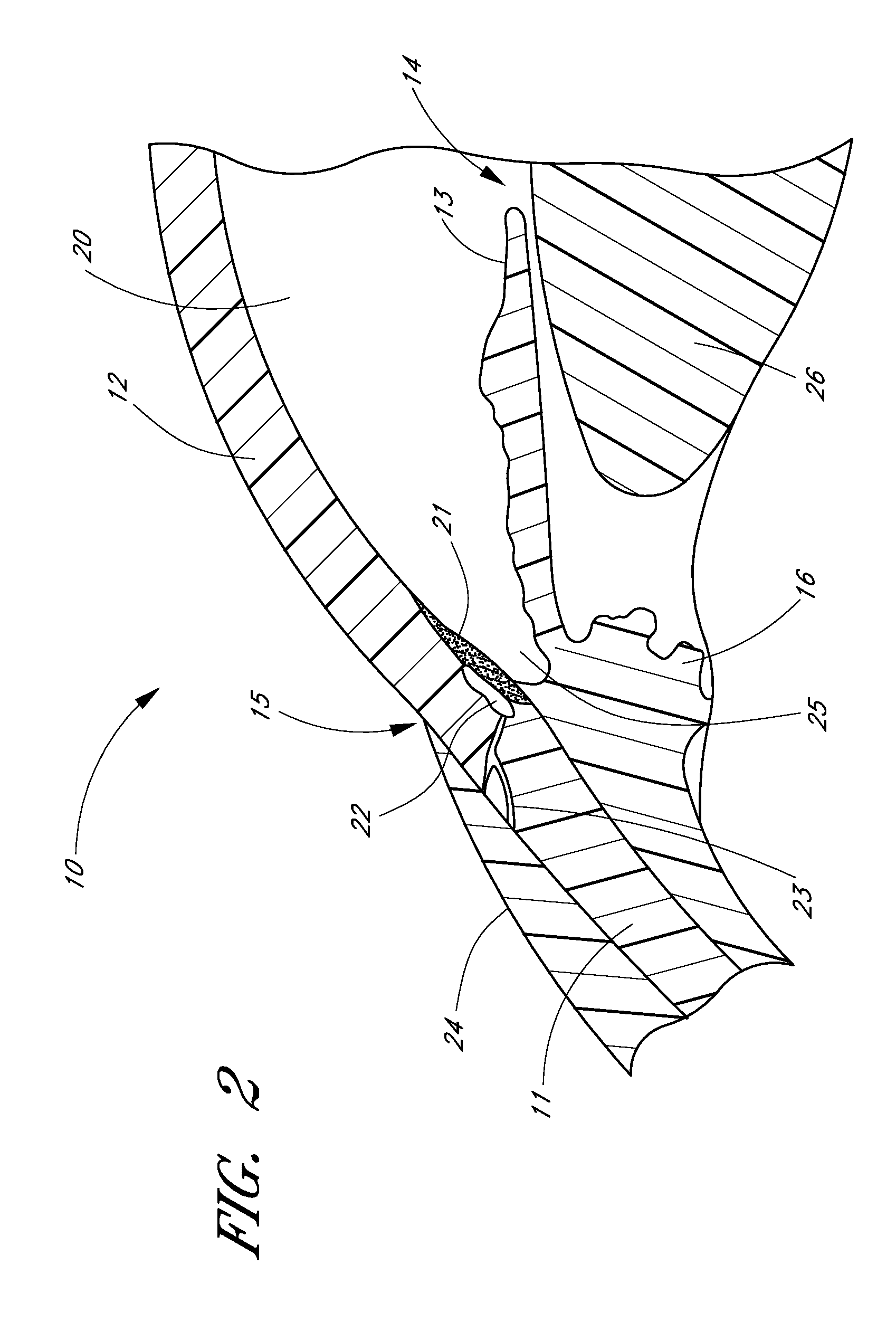 Ocular implant with anchoring mechanism and multiple outlets